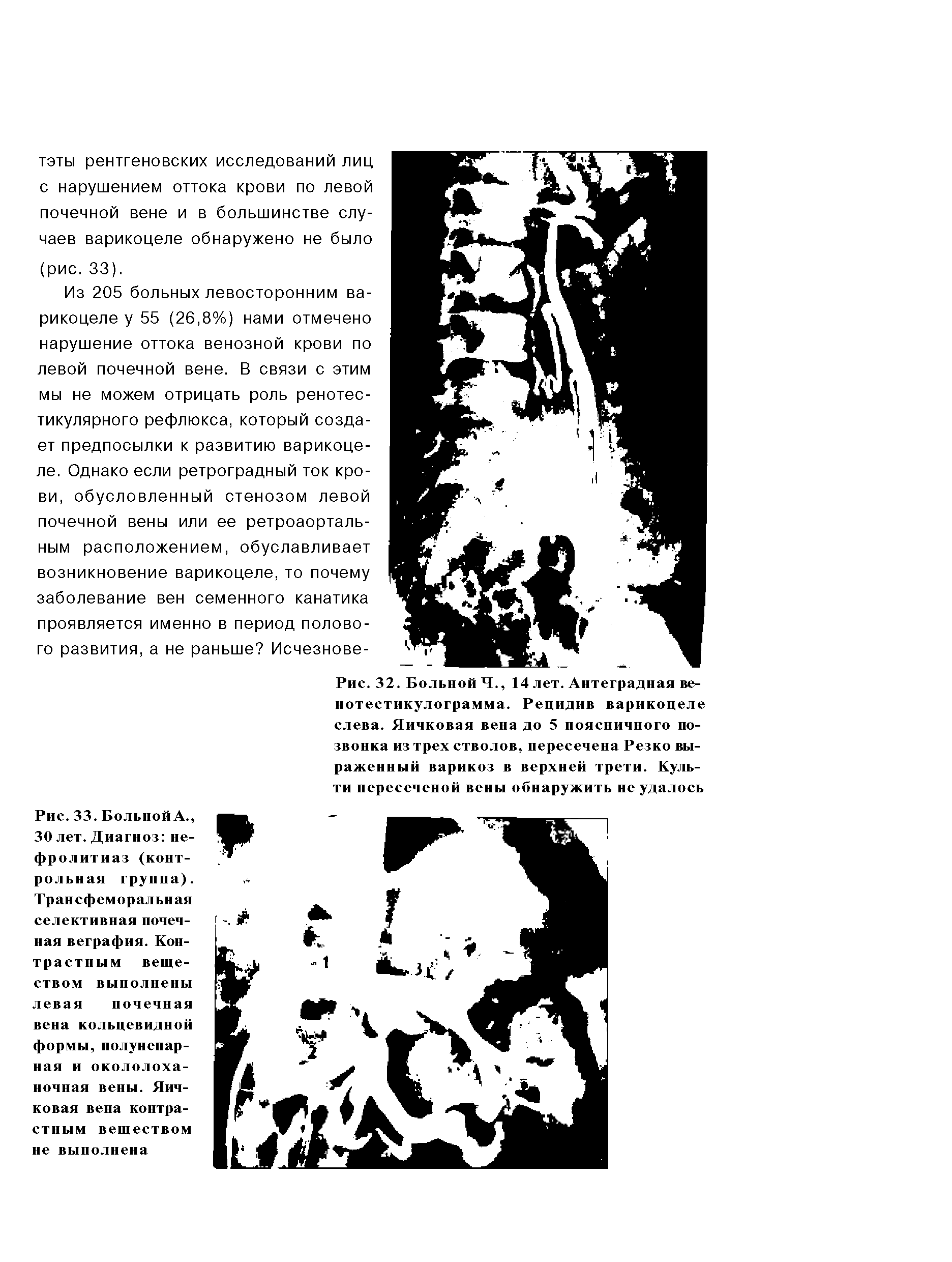 Рис. 33. Больной А., 30 лет. Диагноз нефролитиаз (контрольная группа). Трансфеморальная селективная почечная веграфия. Контрастным веществом выполнены левая почечная вена кольцевидной формы, полунепарная и окололоха-ночная вены. Яичковая вена контрастным веществом не выполнена...
