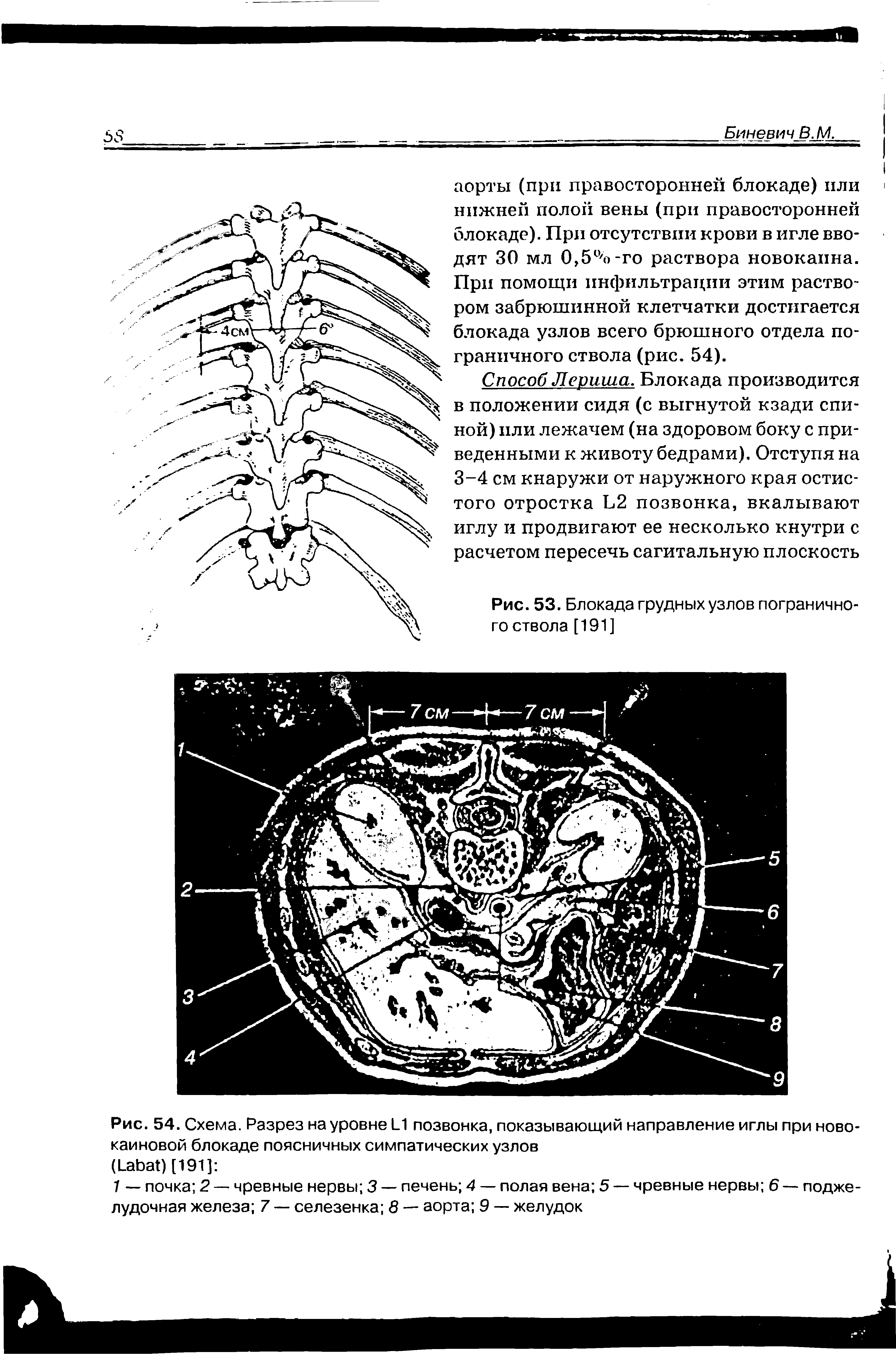 Рис. 54. Схема. Разрез на уровне 1 1 позвонка, показывающий направление иглы при новокаиновой блокаде поясничных симпатических узлов...