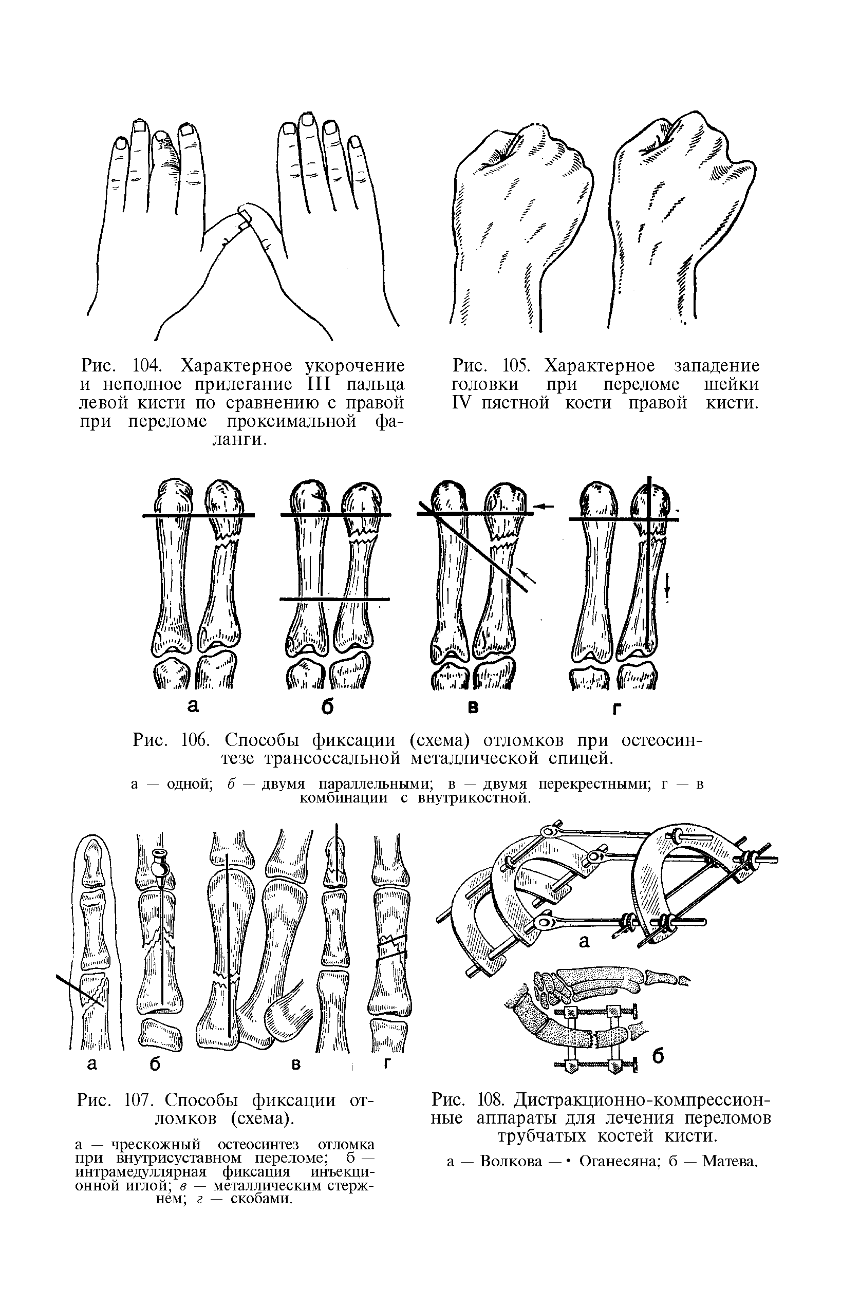 Рис. 108. Дистракционно-компрессионные аппараты для лечения переломов трубчатых костей кисти.