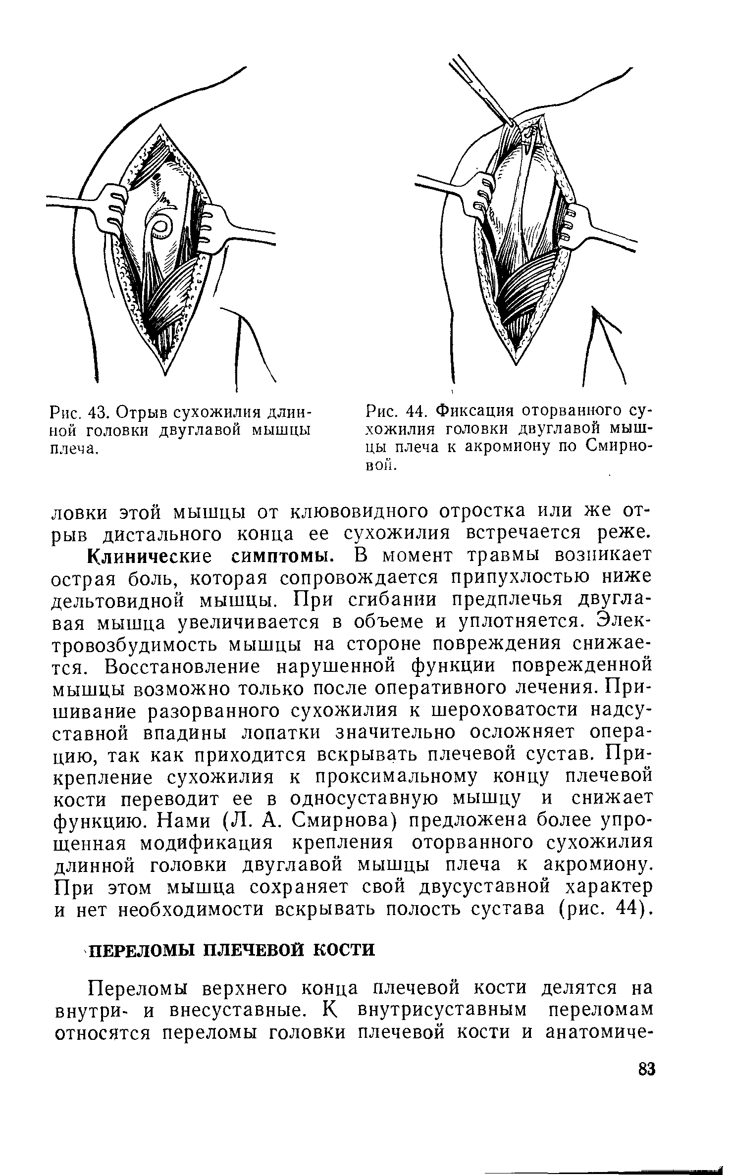 Рис. 44. Фиксация оторванного сухожилия головки двуглавой мышцы плеча к акромиону по Смирновой.