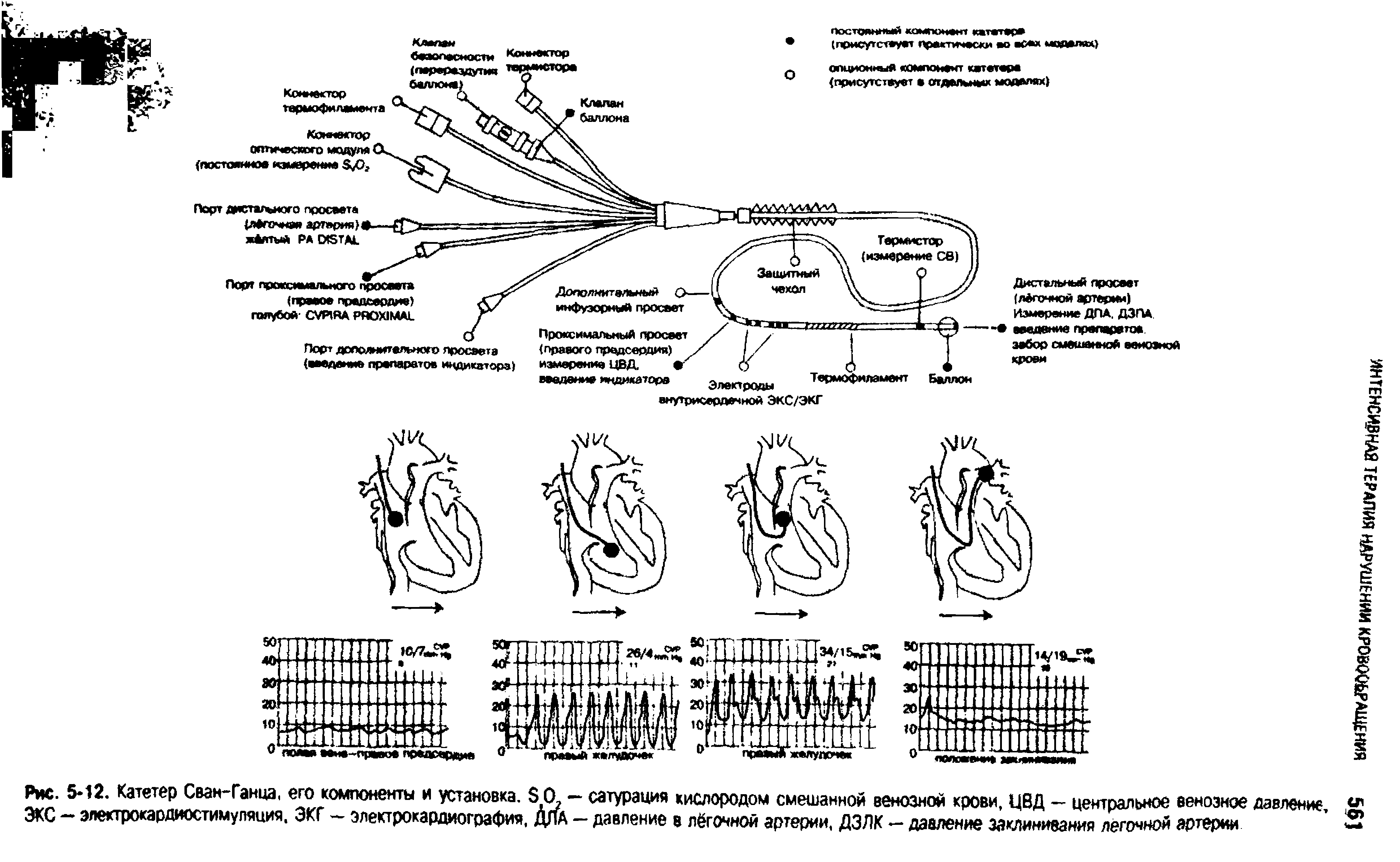 Рис. 5 12. Катетер Сван-Ганца, его компоненты и установка, Э 0 — сатурация кислородом смешанной венозной крови, ЦВД — центральное венозное давление, ЭСС — элекгрокардиостимуляция. ЭКГ — электрокардиография, ДЛА — давление в лёгочной артерии, ДЗЛК — давление заклинивания лёгочной артерии...