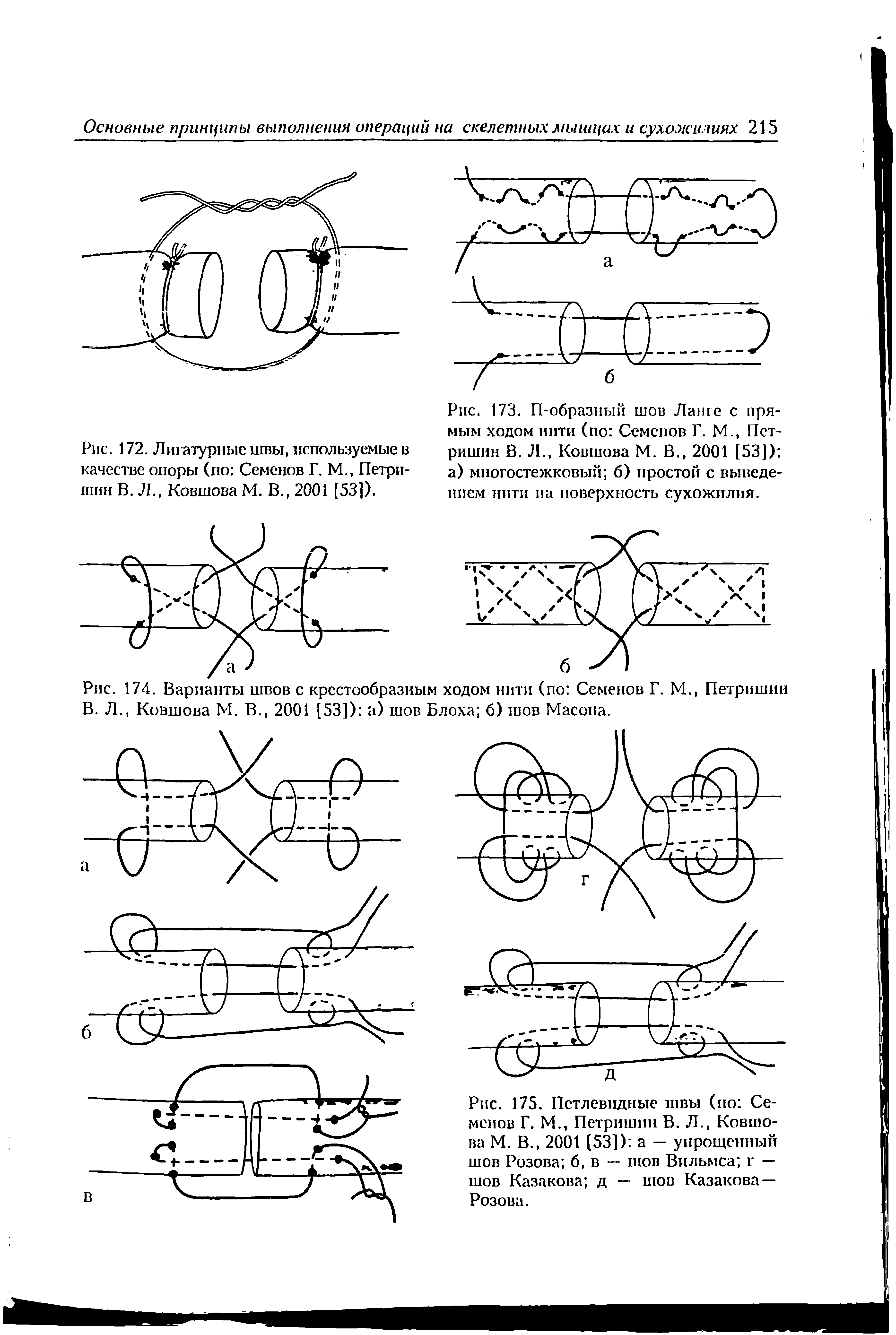 Рис. 173. П-образный шов Ланге с прямым ходом нити (по Семенов Г. М., Пст-ришин В. Л., Ковшова М. В., 2001 [53]) а) многостежковый б) простой с выведением нити па поверхность сухожилия.