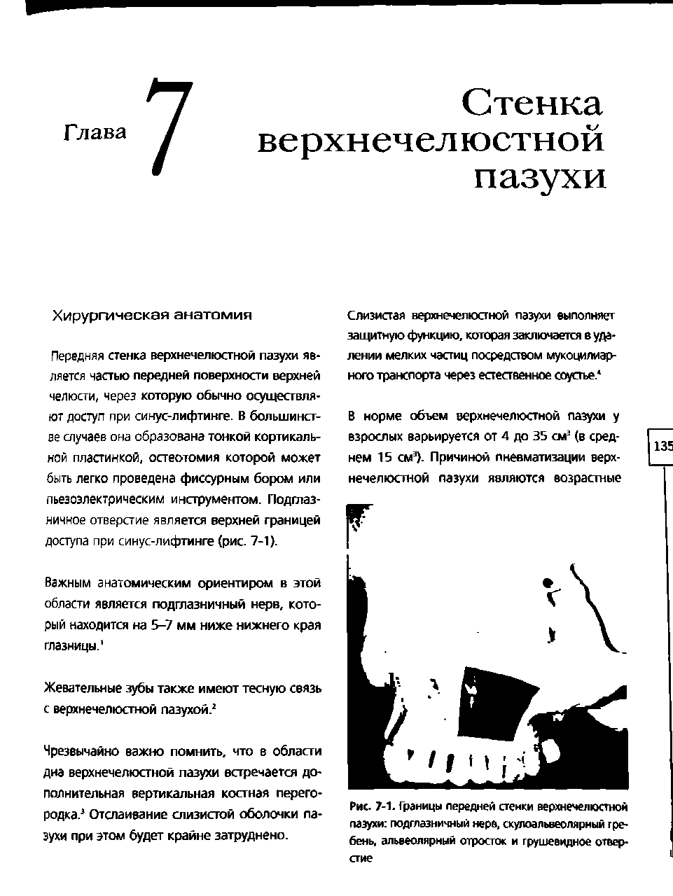 Рис. 7-1. Границы передней стенки верхнечелюстной пазухи подглазничный нерв, скулоальвеолярный гребень, альвеолярный отросток и грушевидное отвер-...