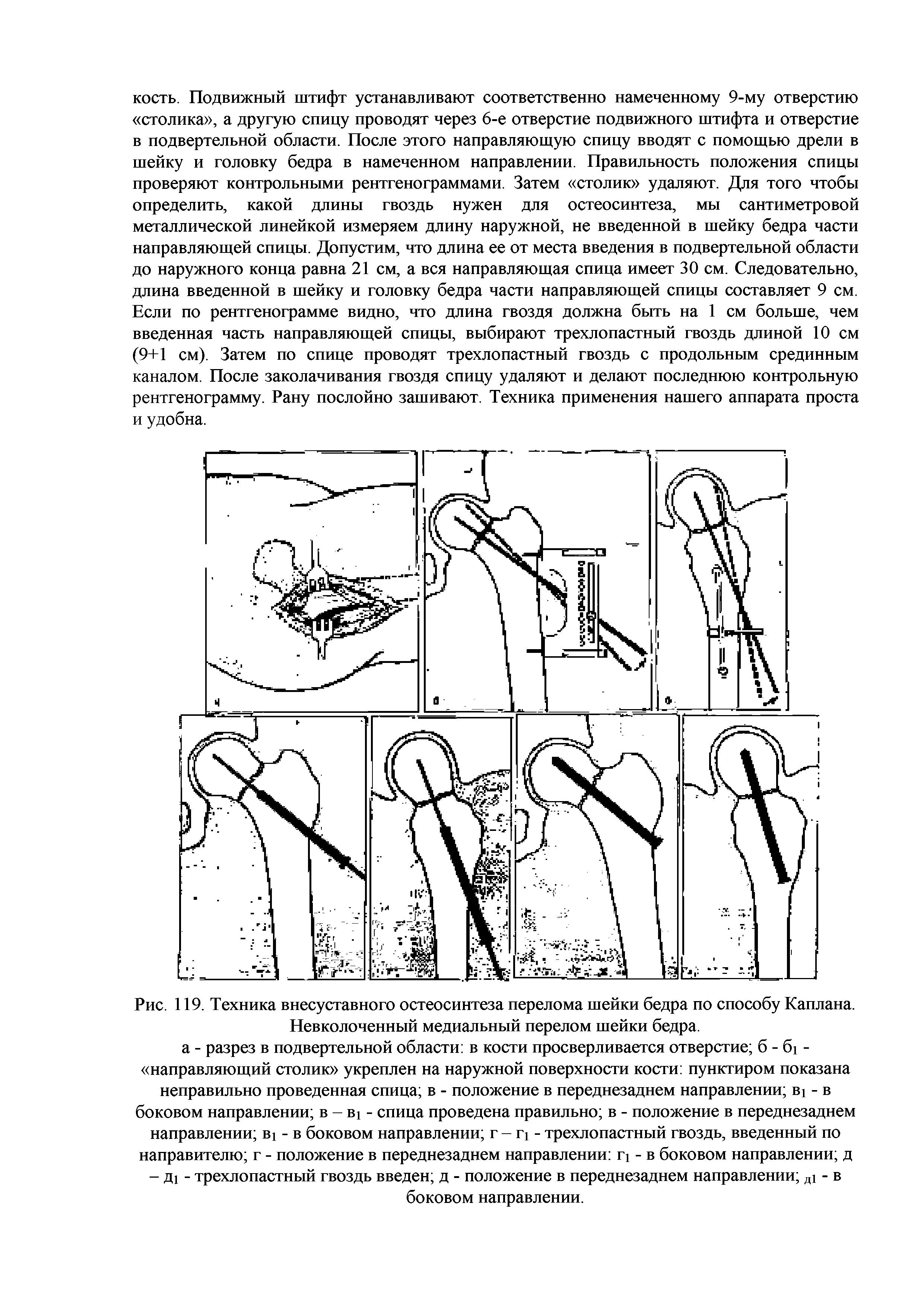 Рис. 119. Техника внесуставного остеосинтеза перелома шейки бедра по способу Каплана. Невколоченный медиальный перелом шейки бедра.