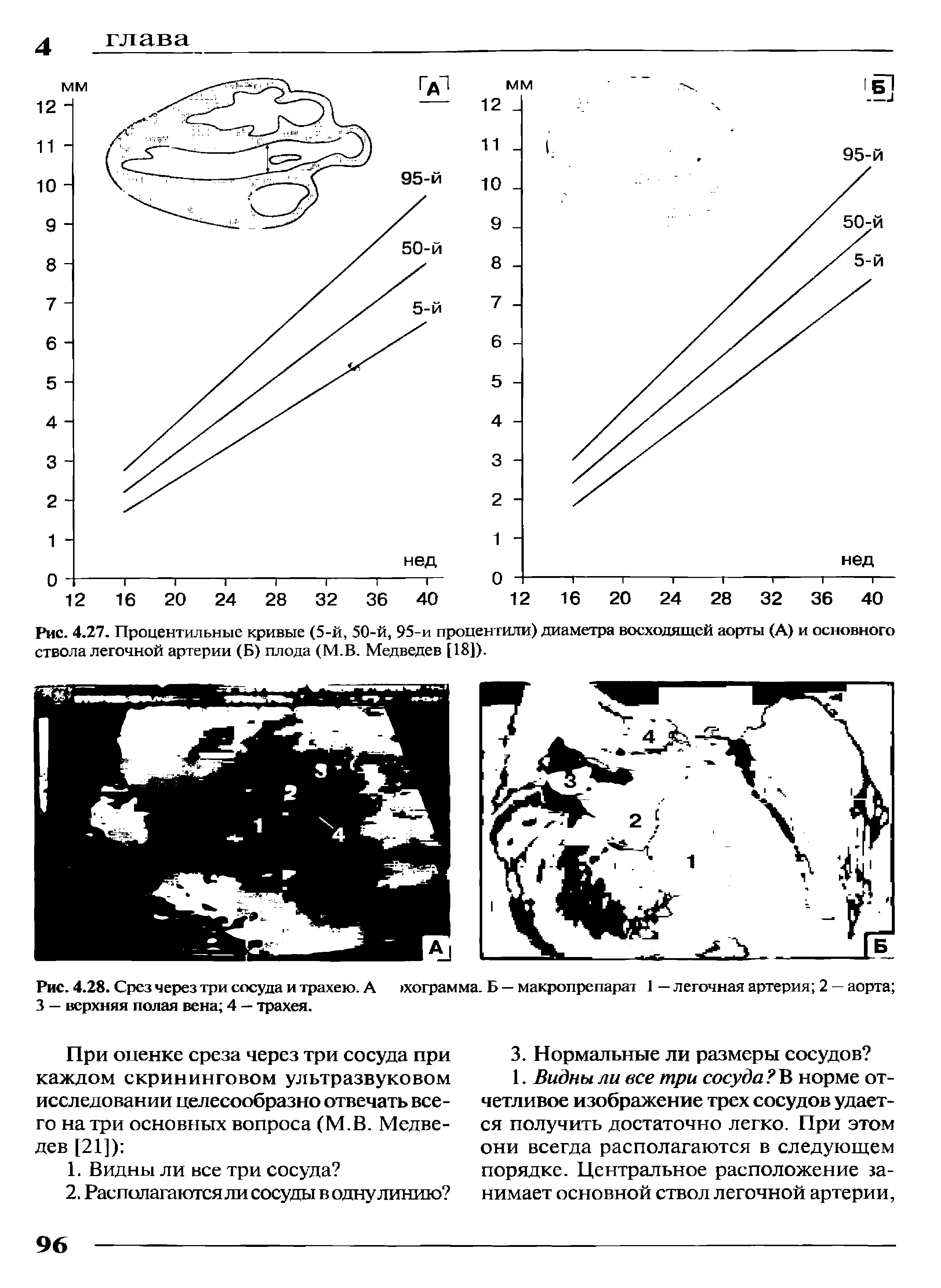 Рис. 4.28. Срез через три сосуда и трахею. А хограмма. Б — макропрепарат 1 — легочная артерия 2 — аорта 3 — верхняя полая вена 4 — трахея.