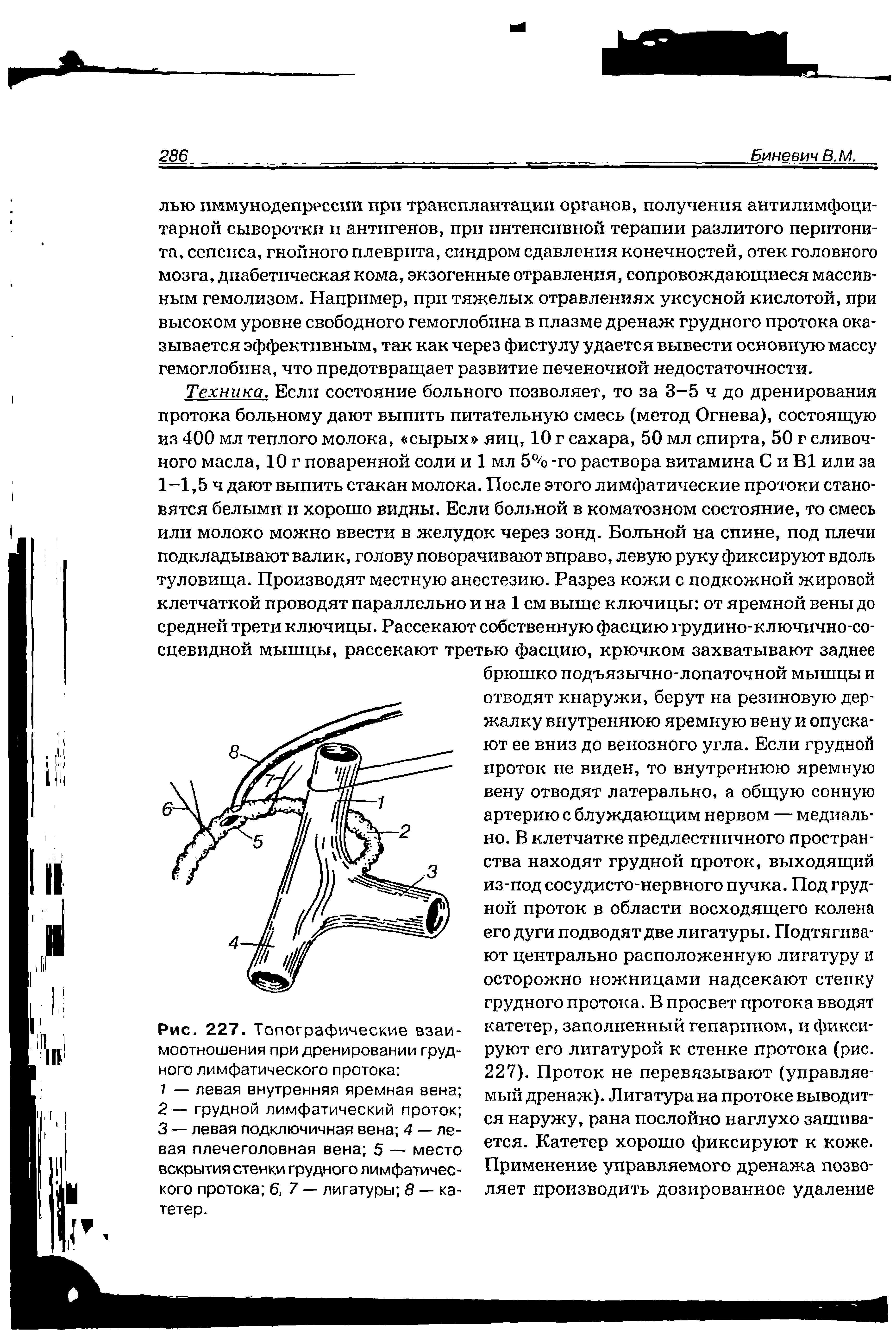 Рис. 227. Топографические взаимоотношения при дренировании грудного лимфатического протока ...