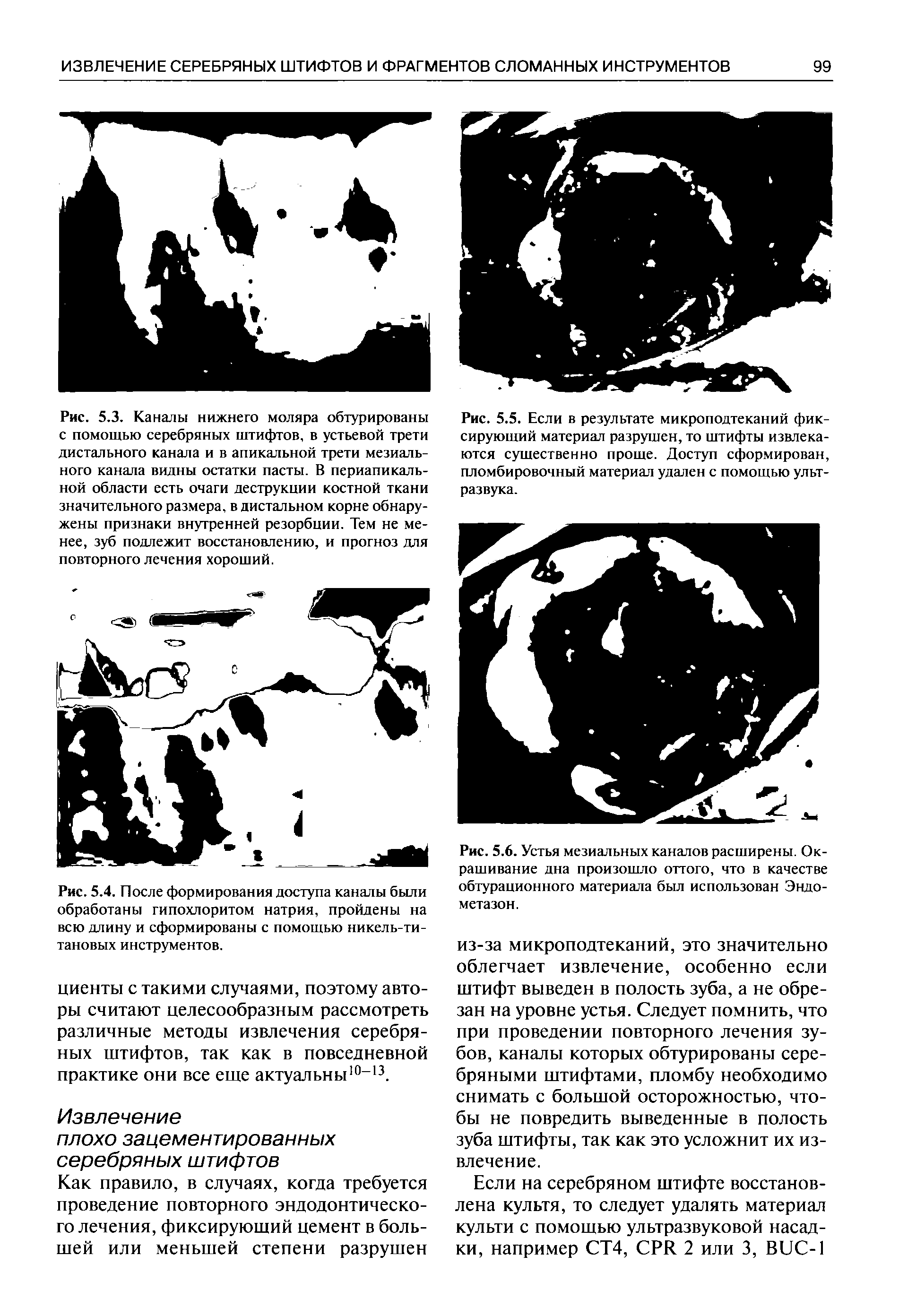 Рис. 5.5. Если в результате микроподтеканий фиксирующий материал разрушен, то штифты извлекаются существенно проще. Доступ сформирован, пломбировочный материал удален с помощью ультразвука.