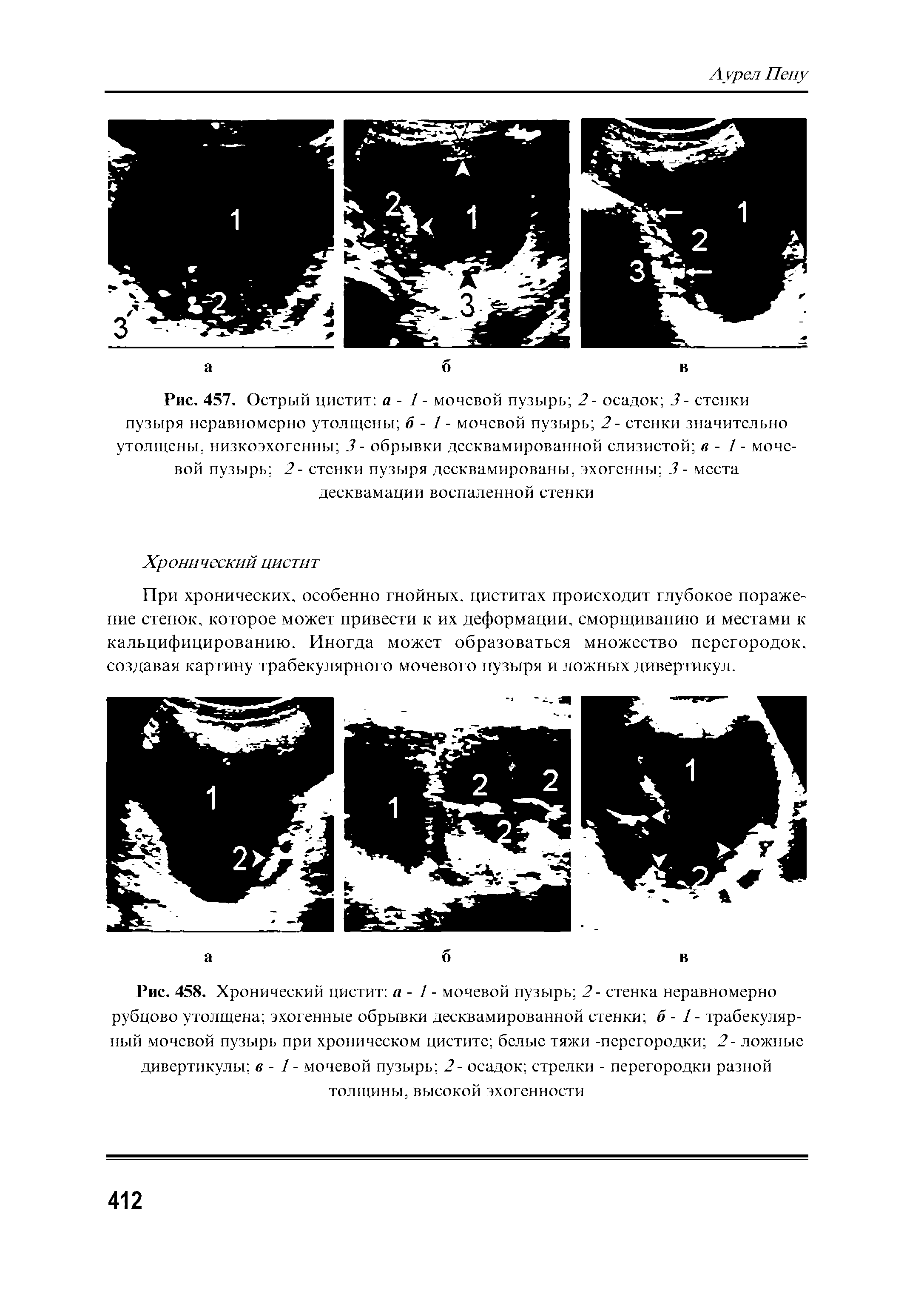 Рис. 458. Хронический цистит а - 1 - мочевой пузырь 2- стенка неравномерно рубцово утолщена эхогенные обрывки десквамированной стенки б - 1 - трабекулярный мочевой пузырь при хроническом цистите белые тяжи -перегородки 2- ложные дивертикулы в - 1 - мочевой пузырь 2- осадок стрелки - перегородки разной толщины, высокой эхогенности...