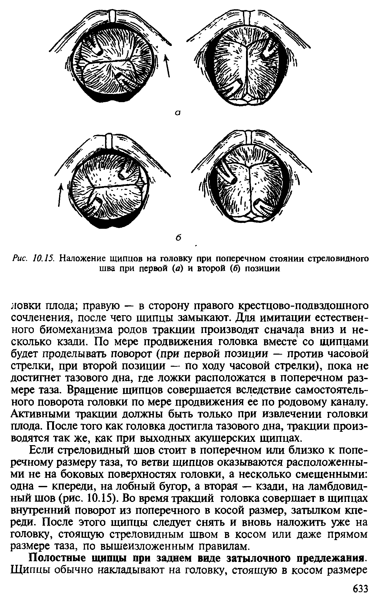 Рис. 10.15. Наложение щипцов на головку при поперечном стоянии стреловидного шва при первой (а) и второй (б) позиции...