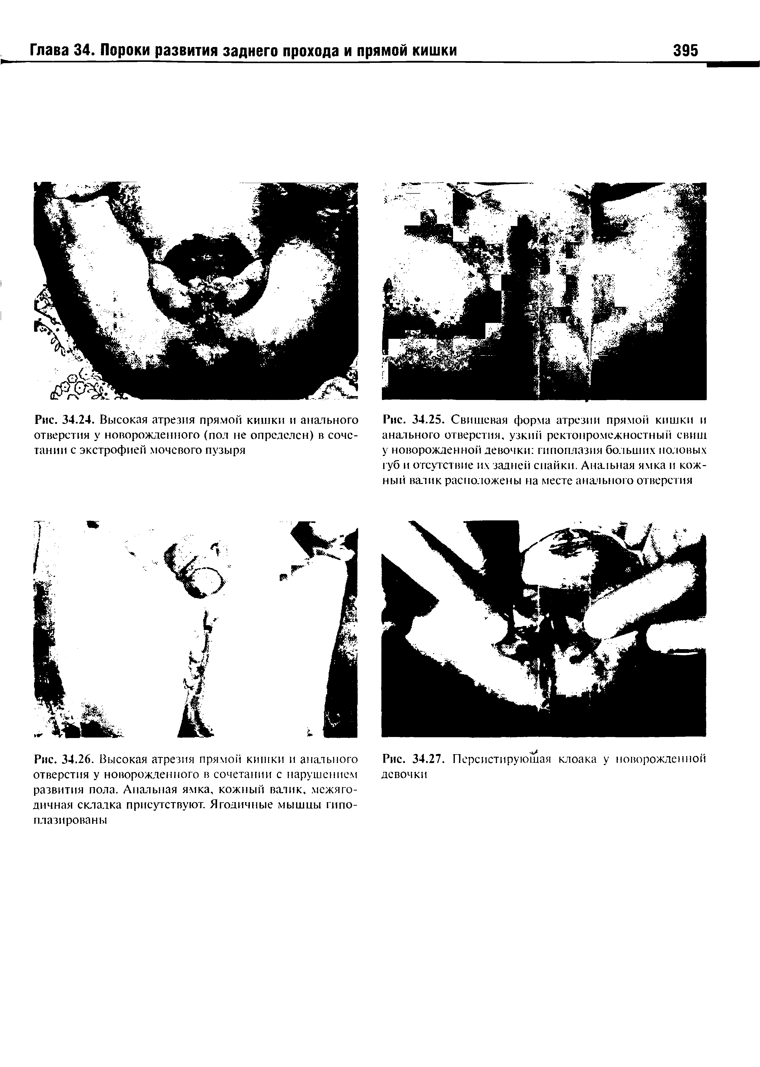 Рис. 34.25. Свишевая форма атрезии прямой кишки и ашыьного отверстия, узкий ректонромежностный евши у новорожденной девочки гипоплазия больших половых губ и отсутствие их задней спайки. Анальная ямка и кожный валик расположены на месте анального отверстия...