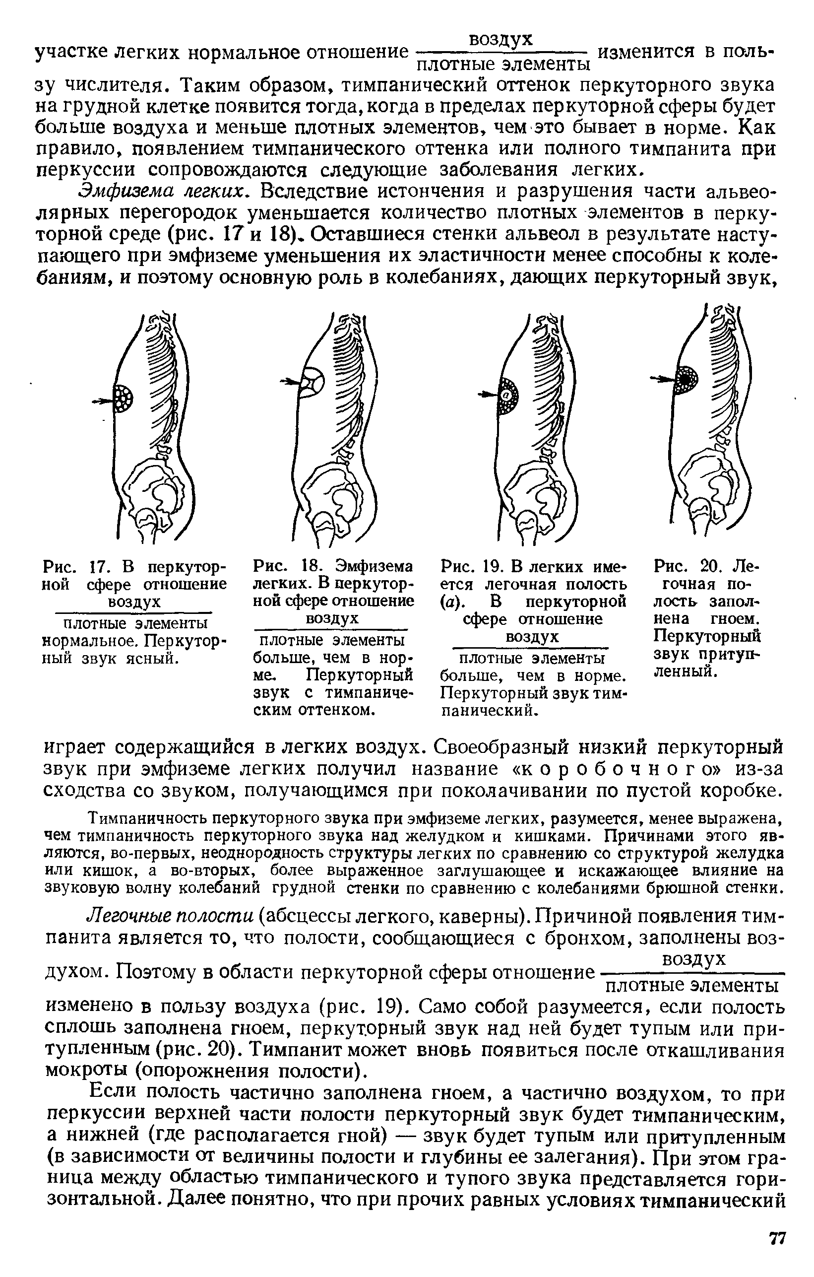 Рис. 18. Эмфизема легких. В перкуторной сфере отношение воздух...