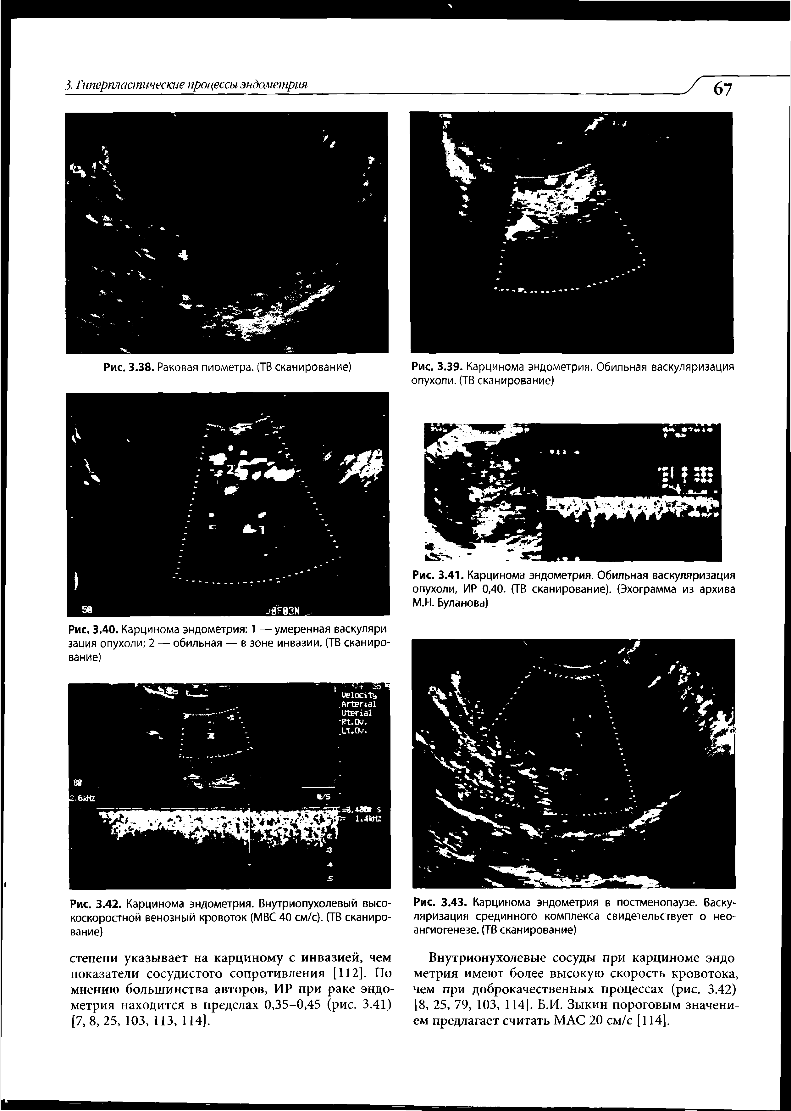 Рис. 3.39. Карцинома эндометрия. Обильная васкуляризация опухоли. (ТВ сканирование)...