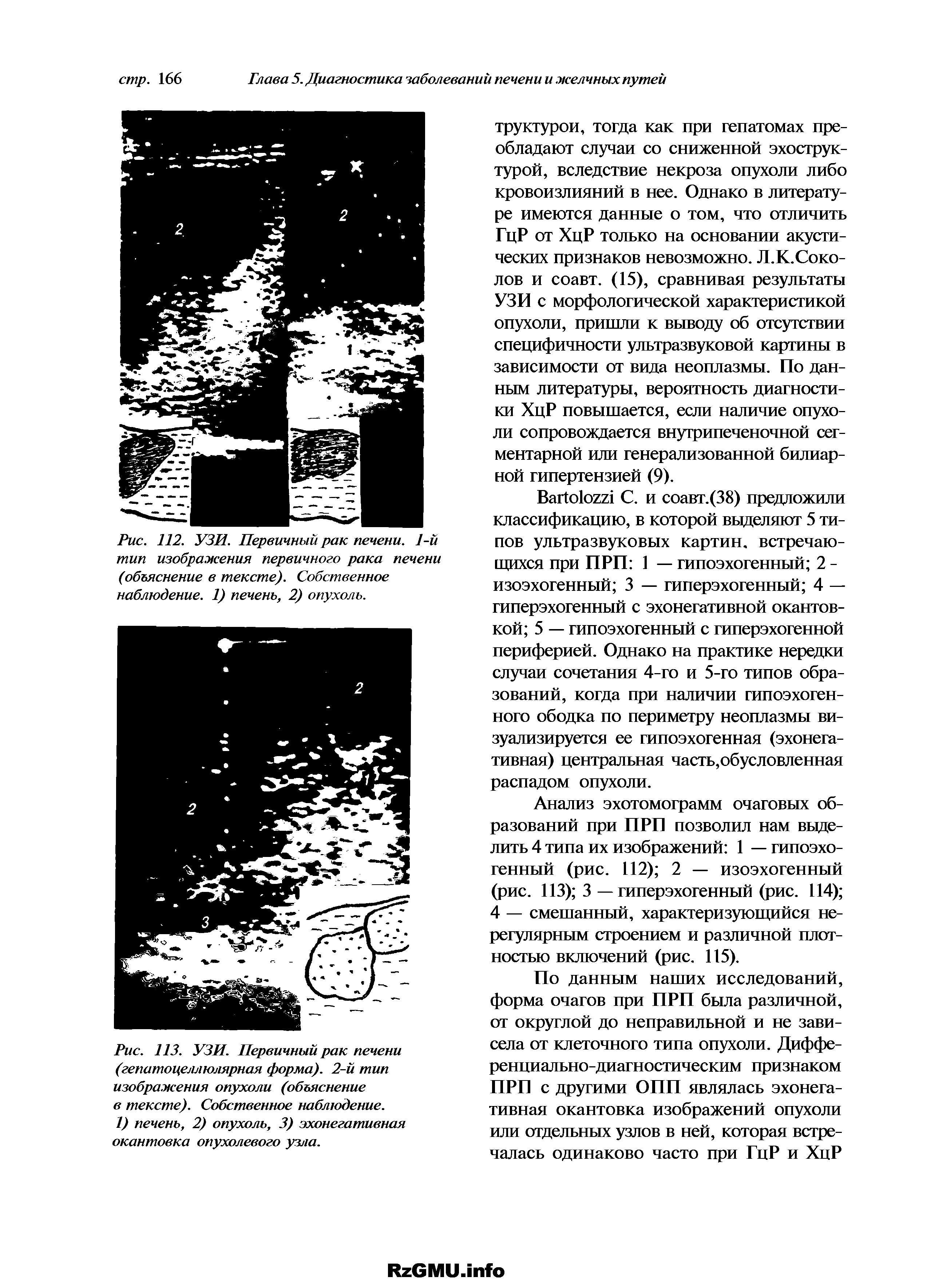 Рис. 113. УЗИ. Первичный рак печени (гепатоцеллюлярная форма). 2-й тип изображения опухоли (объяснение в тексте). Собственное наблюдение.