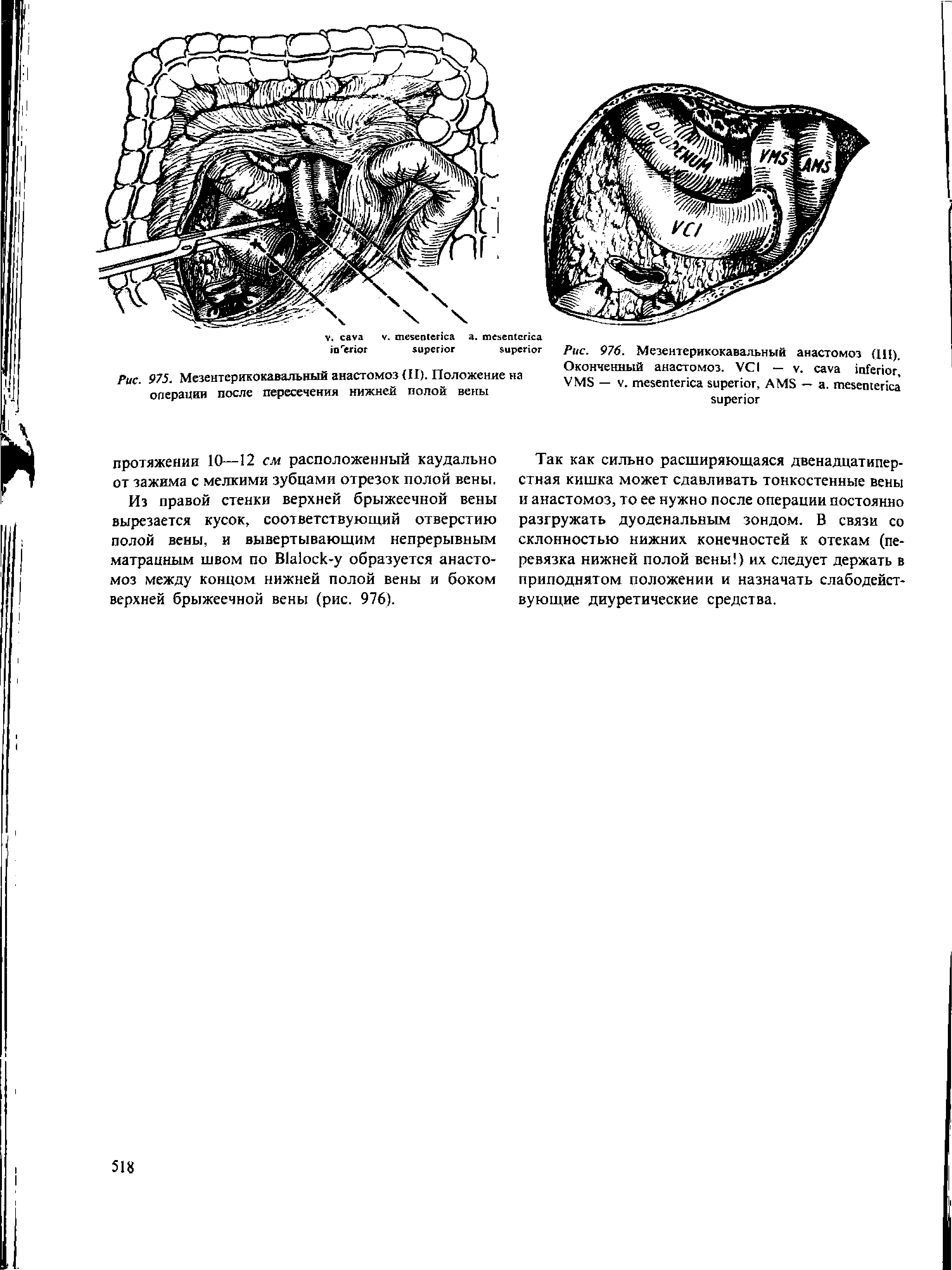 Рис. 976. Мезентерикокавальный анастомоз (Щ). Оконченный анастомоз. VCI — . VMS — . , AMS — . ...