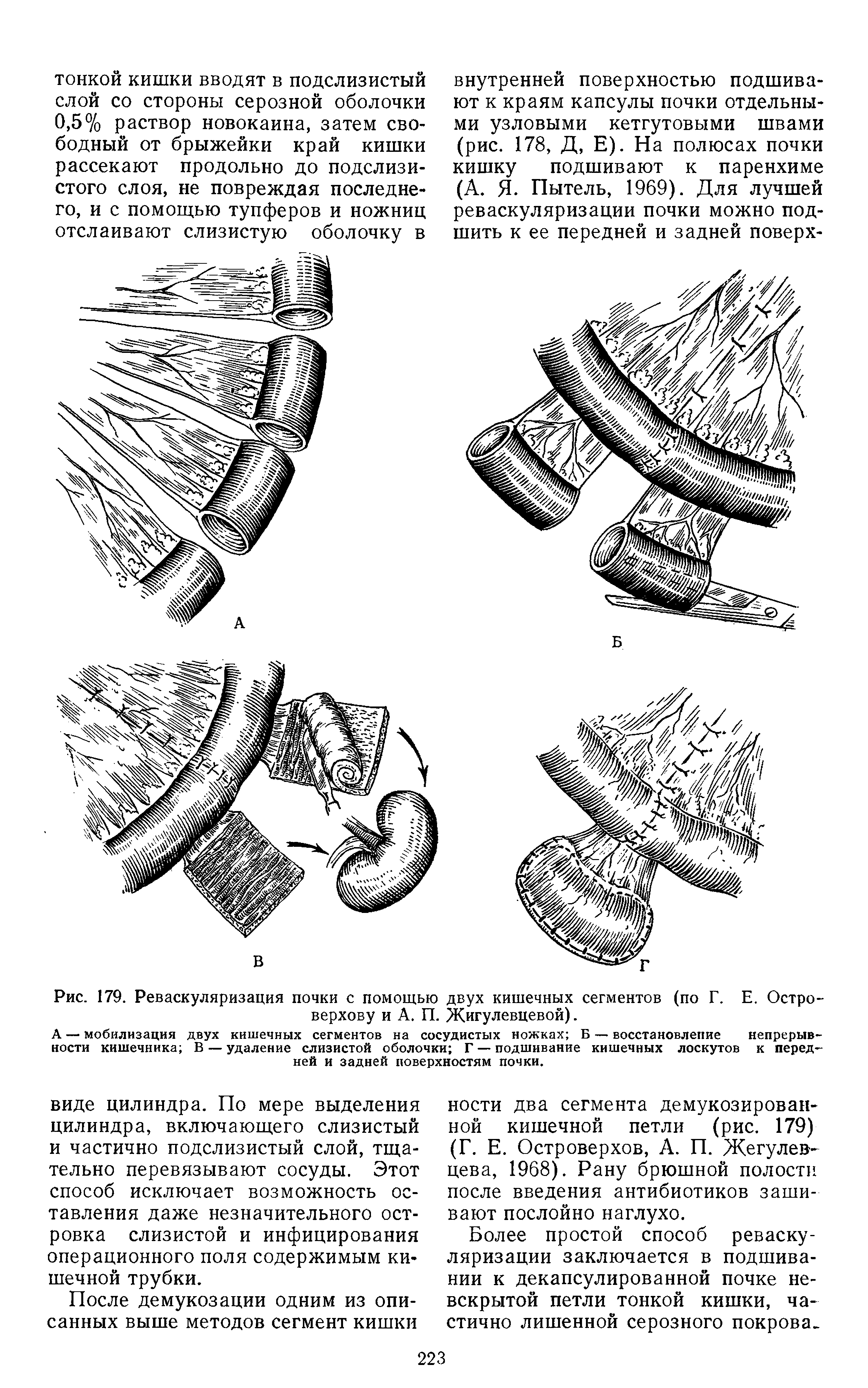 Рис. 179. Реваскуляризация почки с помощью двух кишечных сегментов (по Г. Е. Остро-верхову и А. П. Жигулевцевой).