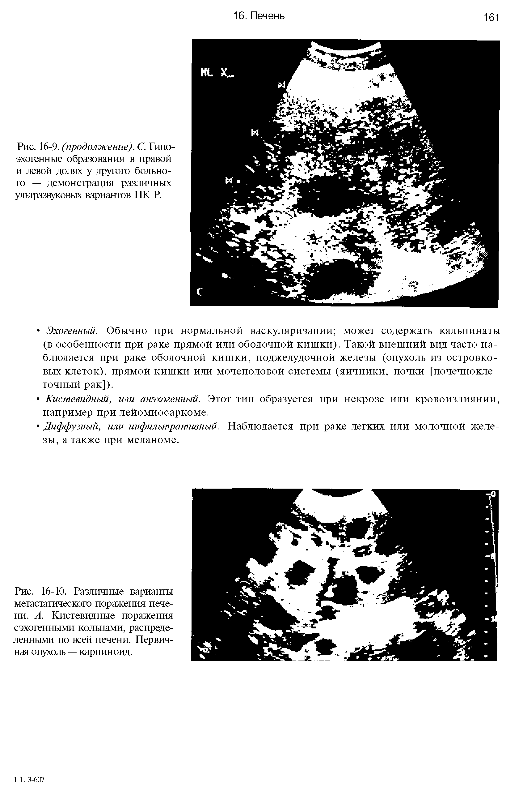 Рис. 16-10. Различные варианты метастатического поражения печени. А. Кистевидные поражения сэхогенными кольцами, распределенными по всей печени. Первичная опухоль — карциноид.
