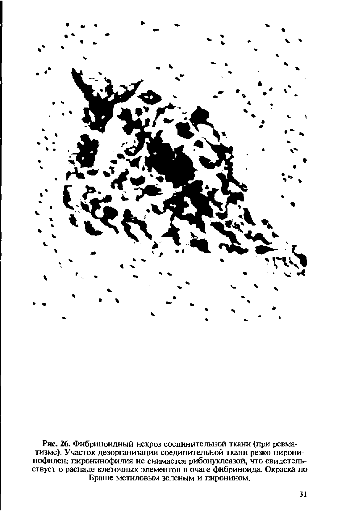 Рис. 26. Фибриноидный некроз соединительной ткани (при ревматизме). Участок дезорганизации соединительной ткани резко пирони-нофилен пиронинофилия ие снимается рибонуклеазой, что свидетельствует о распаде клеточных элементов в очаге фибриноида. Окраска по Браше метиловым зеленым и пиронином.
