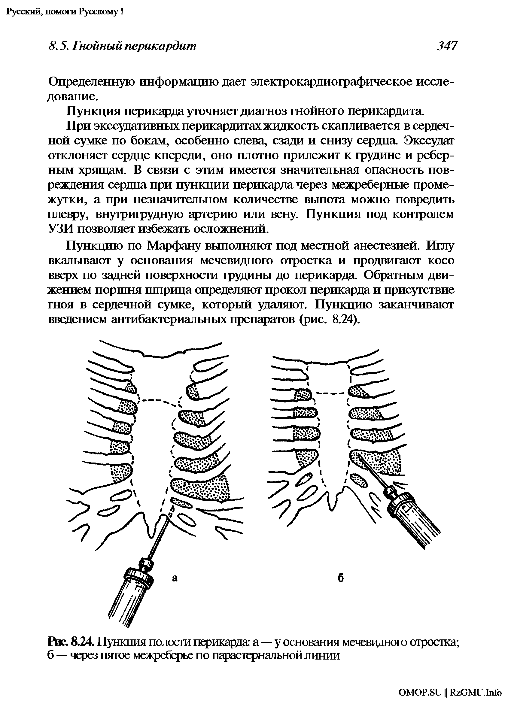 Рис. 8.24. Пункция полости перикарда а—у основания мечевидного отростка б — через пятое межреберье по парастернатьной линии...