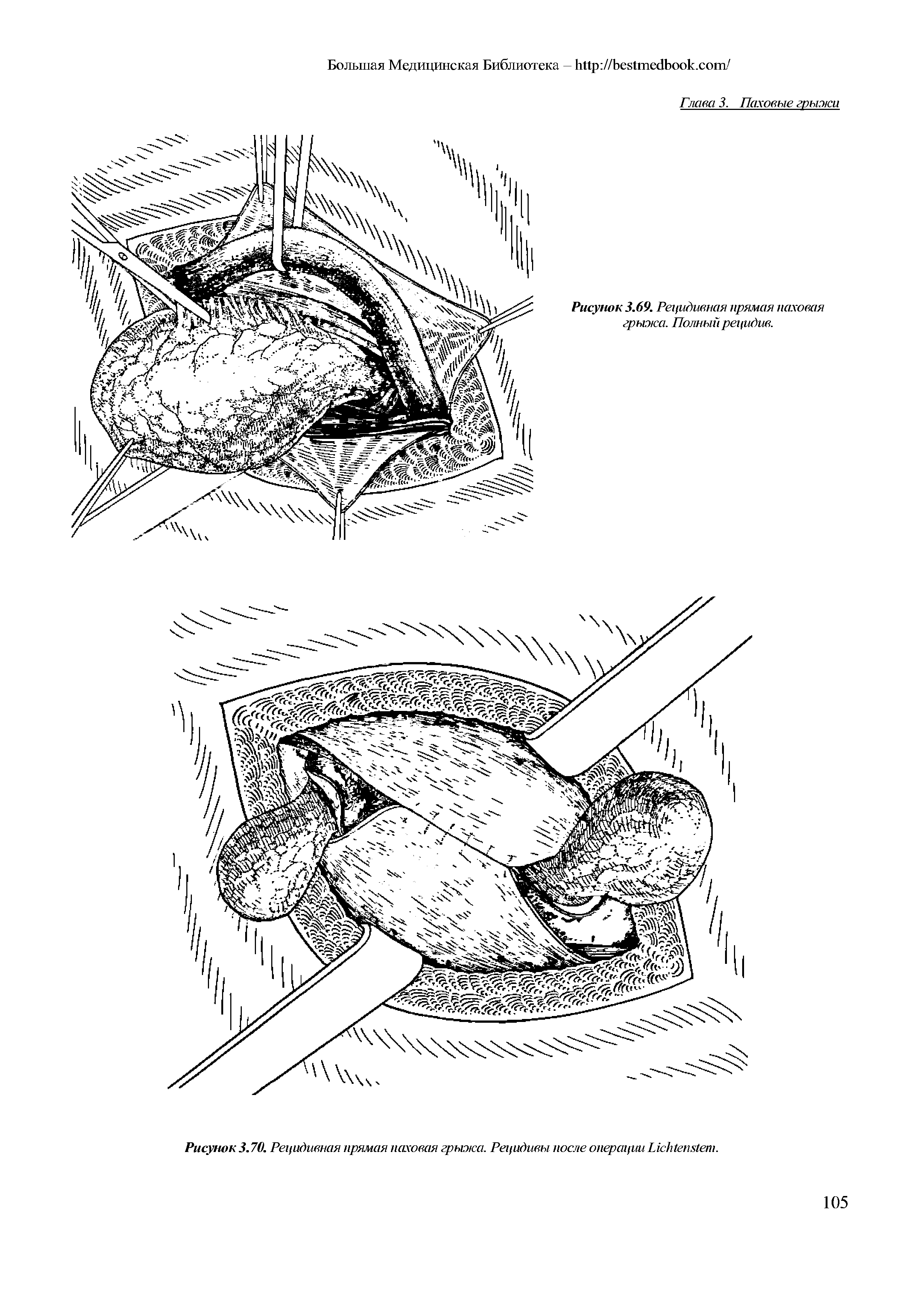Рисунок 3.70. Рецидивная прямая паховая грыжа. Рецидивы после операции L .