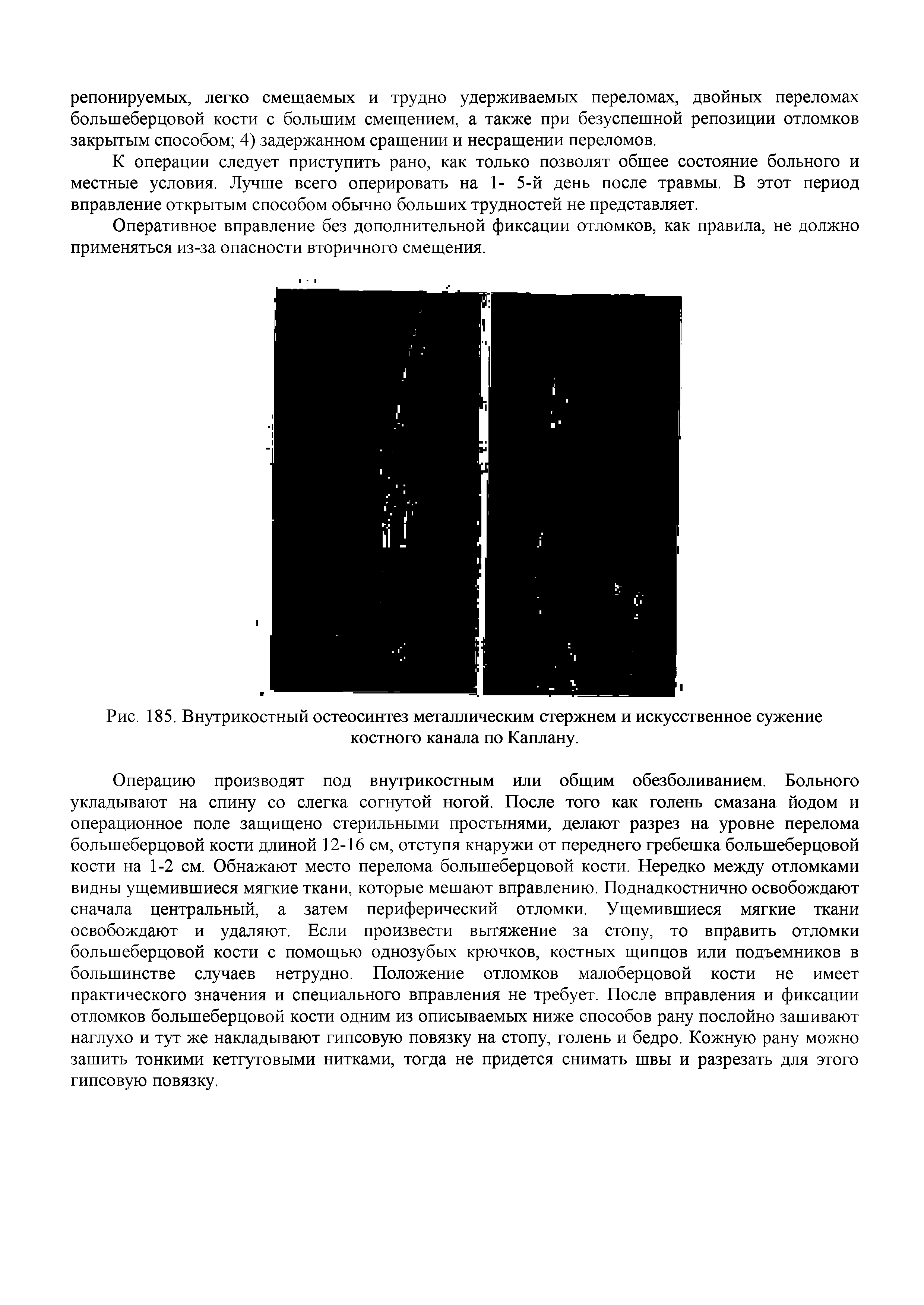 Рис. 185. Внутрикостный остеосинтез металлическим стержнем и искусственное сужение костного канала по Каплану.