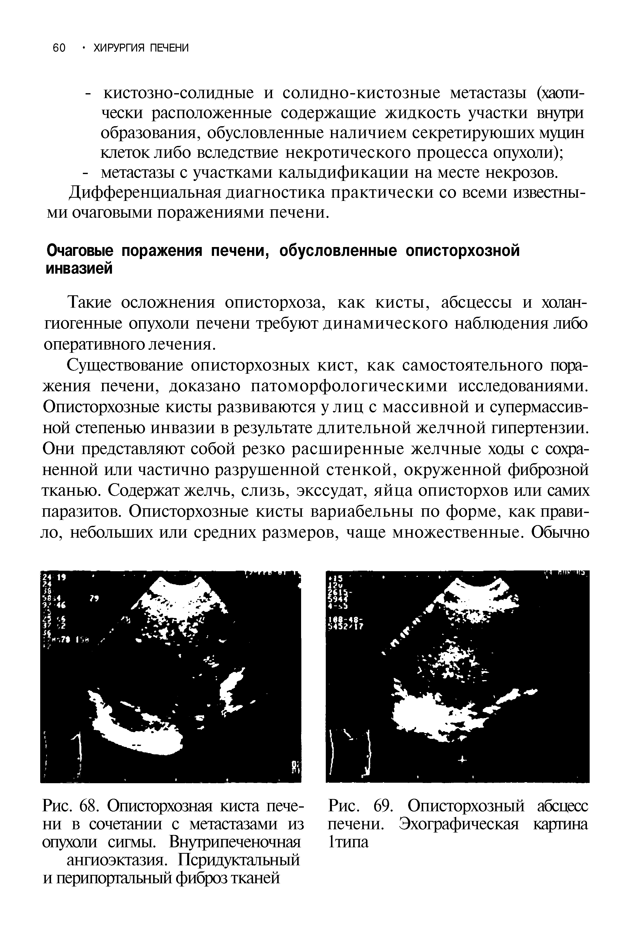 Рис. 68. Описторхозная киста печени в сочетании с метастазами из опухоли сигмы. Внугрипеченочная ангиоэкгазия. Псридукгальный и перипортальный фиброз тканей...