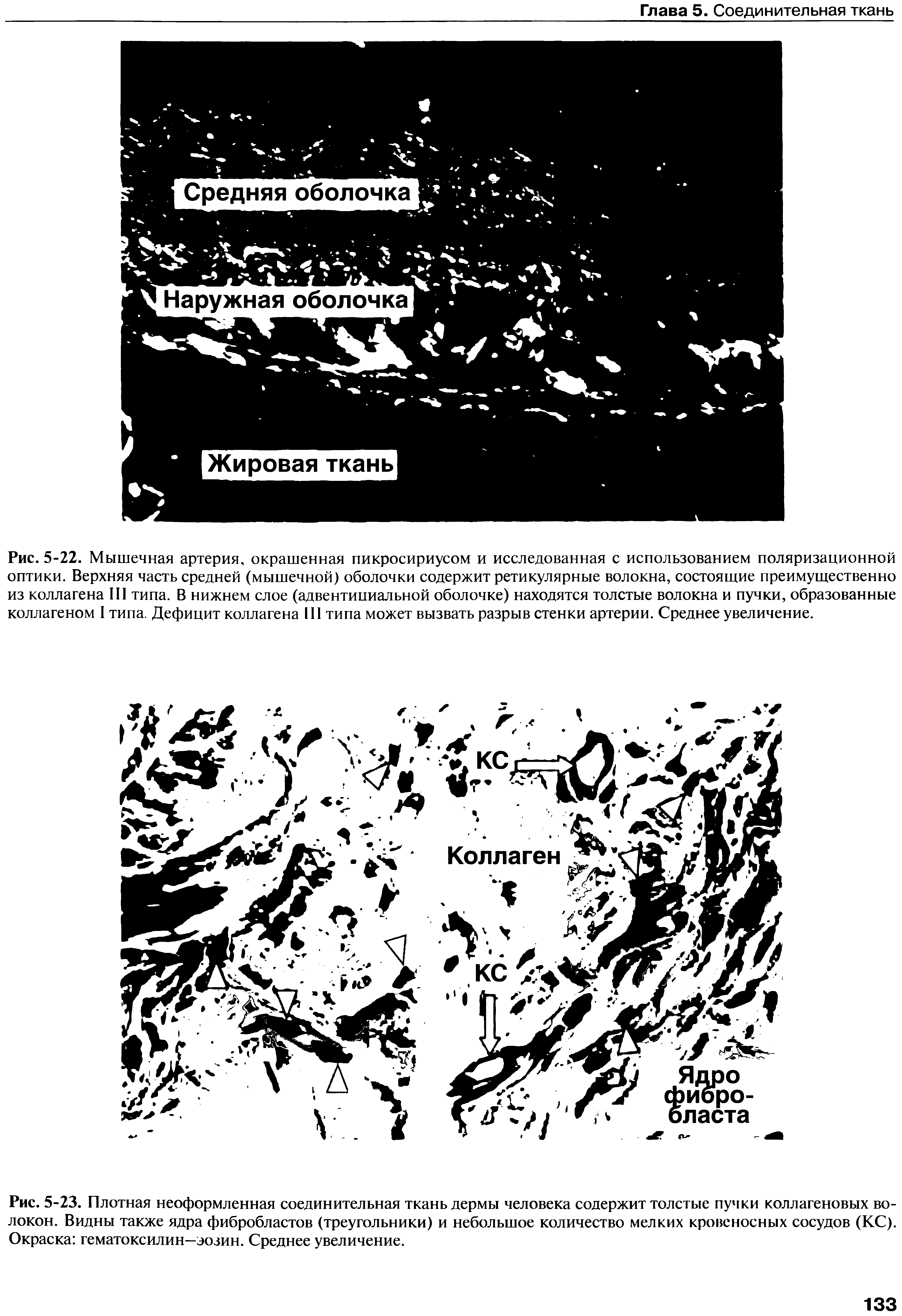 Рис. 5-23. Плотная неоформленная соединительная ткань дермы человека содержит толстые пучки коллагеновых волокон. Видны также ядра фибробластов (треугольники) и небольшое количество мелких кровеносных сосудов (КС). Окраска гематоксилин—эозин. Среднее увеличение.