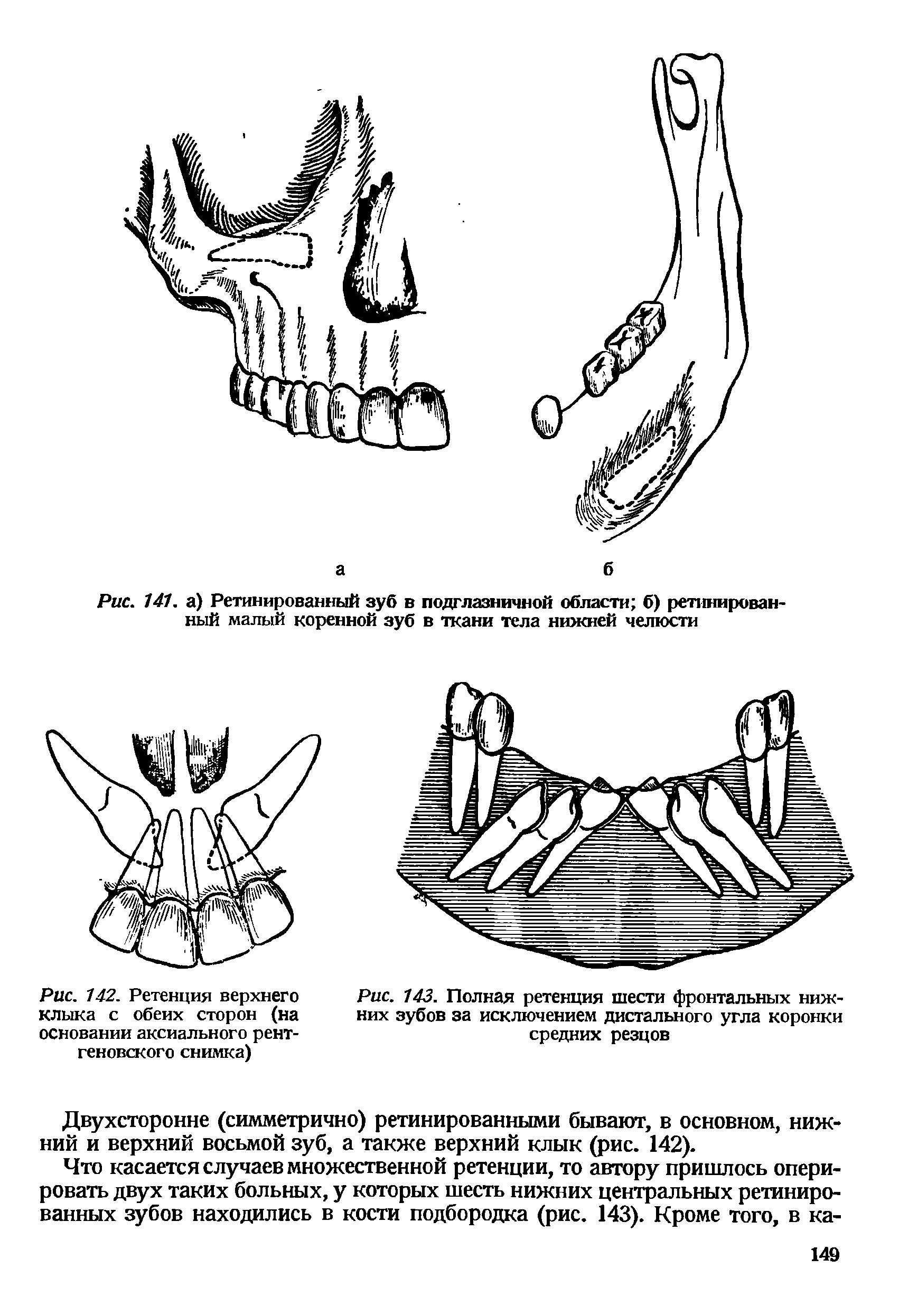 Рис. 142. Ретенция верхнего клыка с обеих сторон (на основании аксиального рентгеновского снимка)...