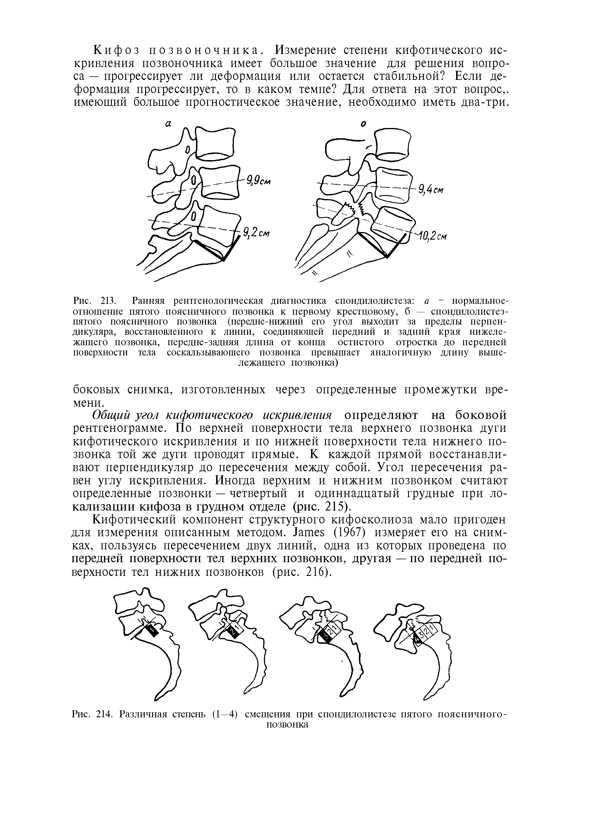 Рис. 214. Различная степень (1—4) смещения при спондилолистезе пятого поясничного-позвонка...