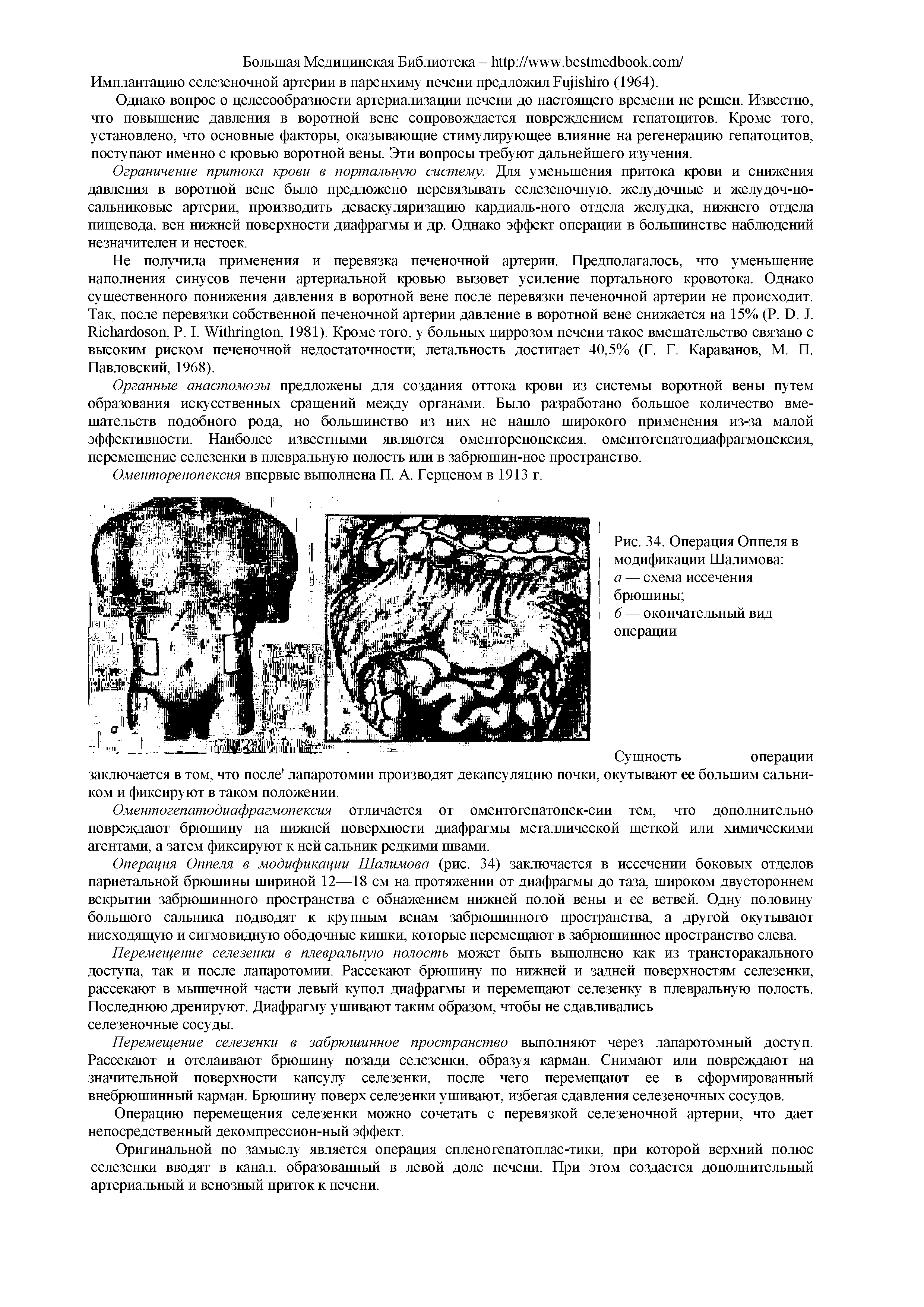 Рис. 34. Операция Оппеля в модификации Шалимова а — схема иссечения брюшины ...