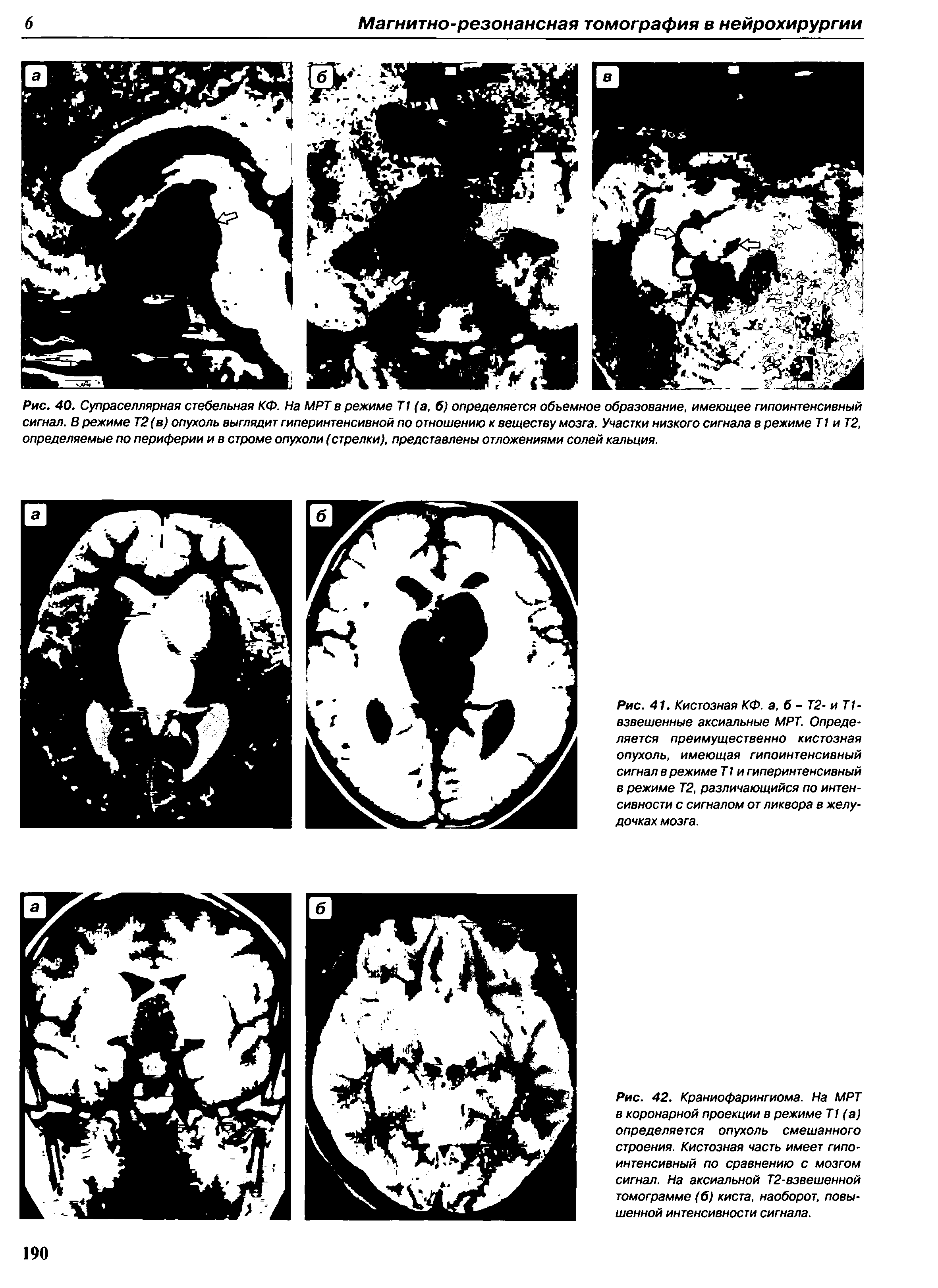 Рис. 42. Краниофарингиома. На МРТ в коронарной проекции в режиме Т1 (а) определяется опухоль смешанного строения. Кистозная часть имеет гипоинтенсивный по сравнению с мозгом сигнал. На аксиальной Т2-взвешенной томограмме (б) киста, наоборот, повышенной интенсивности сигнала.