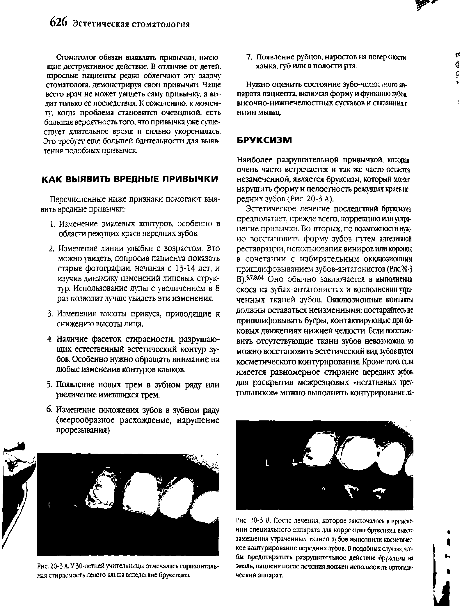 Рис. 20-3 В. После лечения, которое заключалось в применении специального аппарата для коррекции бруксизма. вмссю замещения утраченных тканей зубов выполнили косметическое контурирование передних зубов. В подобных случаях. чтобы предотвратить разрушительное действие бруксизма на эмаль, пациент после лечения должен использовать ортопедический аппарат.