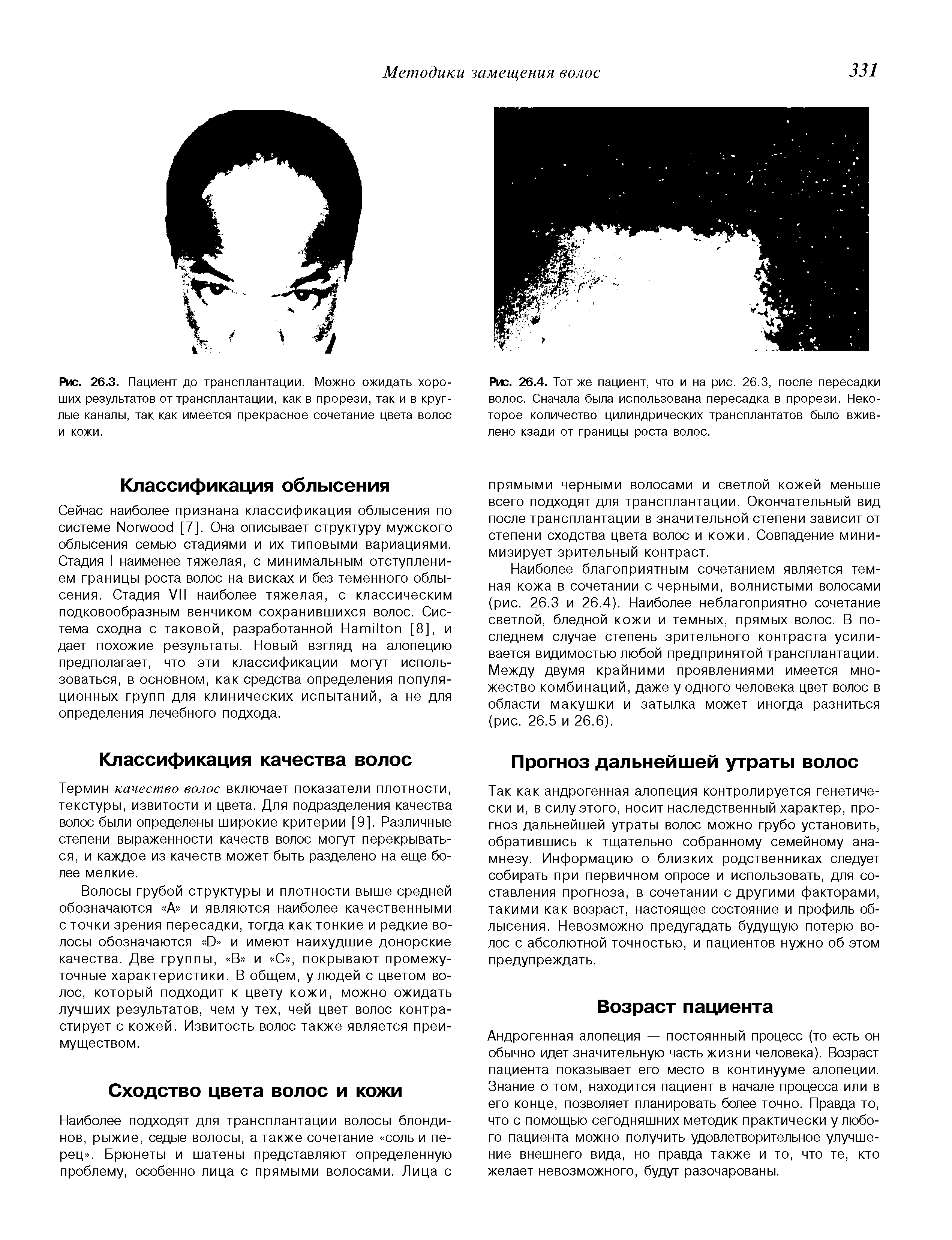 Рис. 26.4. Тот же пациент, что и на рис. 26.3, после пересадки волос. Сначала была использована пересадка в прорези. Некоторое количество цилиндрических трансплантатов было вживлено кзади от границы роста волос.