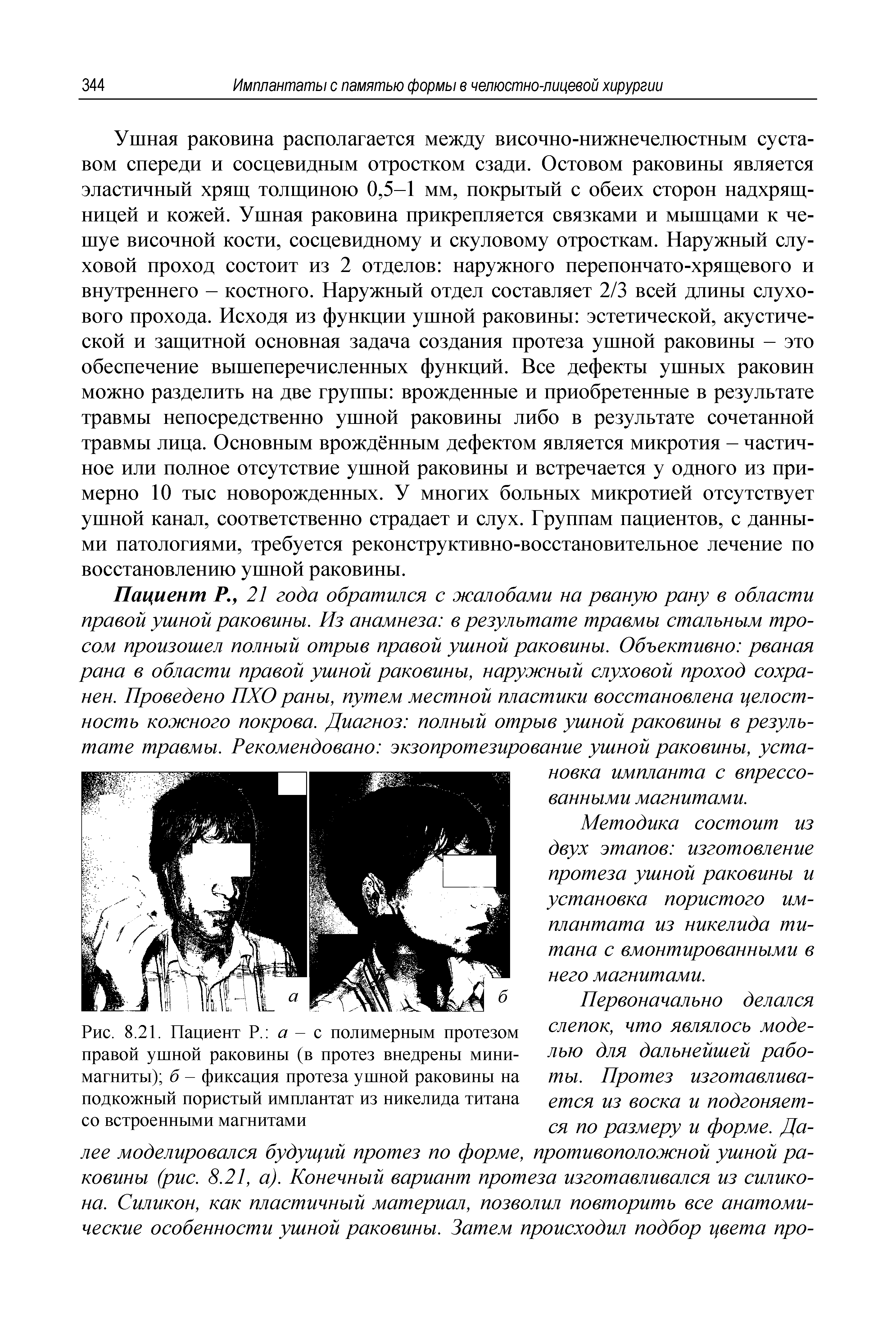 Рис. 8.21. Пациент Р. а - с полимерным протезом правой ушной раковины (в протез внедрены минимагниты) б - фиксация протеза ушной раковины на подкожный пористый имплантат из никелида титана...