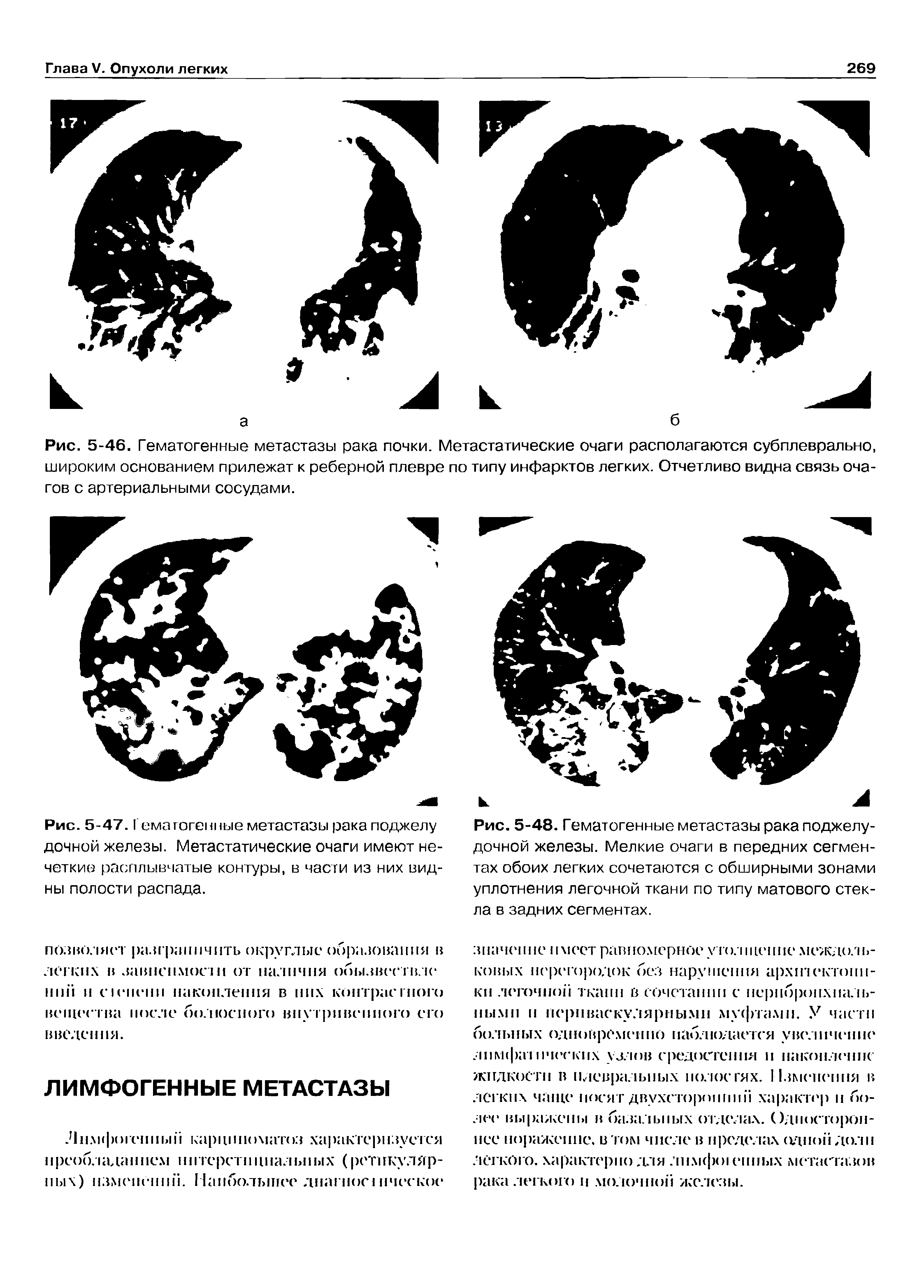 Рис. 5-47. Гематогенные метастазы рака гюджелу дочной железы. Метастатические очаги имеют нечеткие расплывчатые контуры, в части из них видны полости распада.