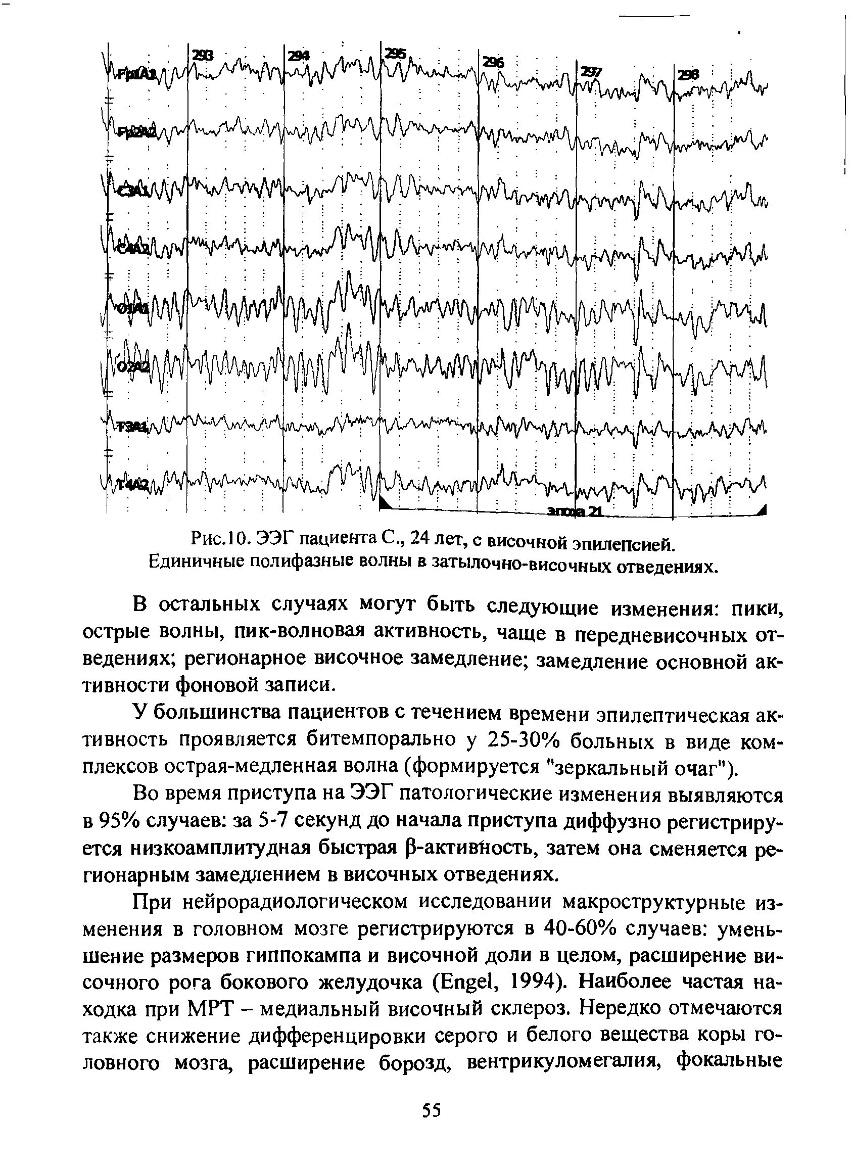 Рис. 10. ЭЭГ пациента С., 24 лет, с височной эпилепсией. Единичные полифазные волны в затылочно-височных отведениях.