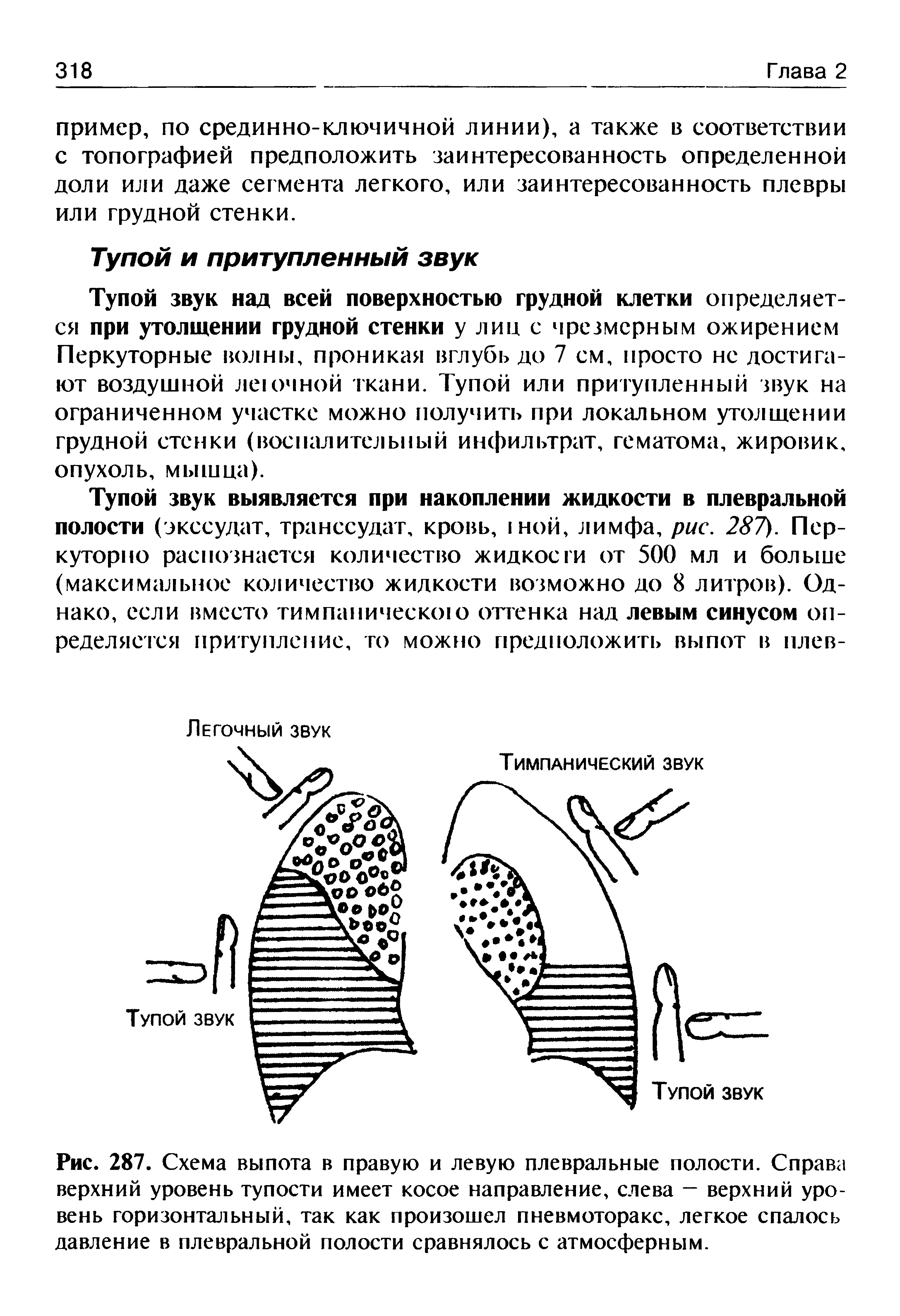 Рис. 287. Схема выпота в правую и левую плевральные полости. Справа верхний уровень тупости имеет косое направление, слева — верхний уровень горизонтальный, так как произошел пневмоторакс, легкое спалось давление в плевральной полости сравнялось с атмосферным.