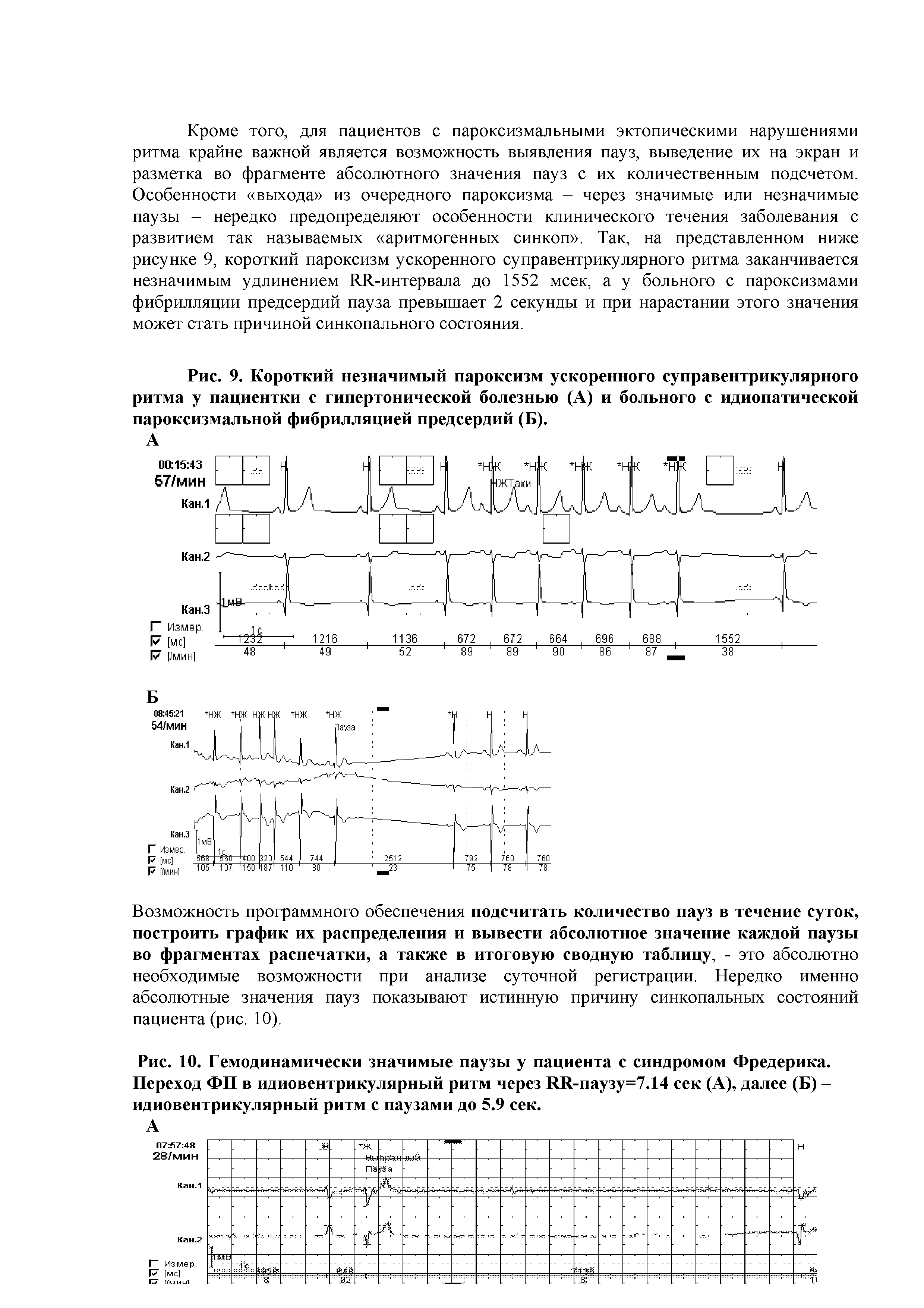 Рис. 9. Короткий незначимый пароксизм ускоренного суправентрикулярного ритма у пациентки с гипертонической болезнью (А) и больного с идиопатической пароксизмальной фибрилляцией предсердий (Б).