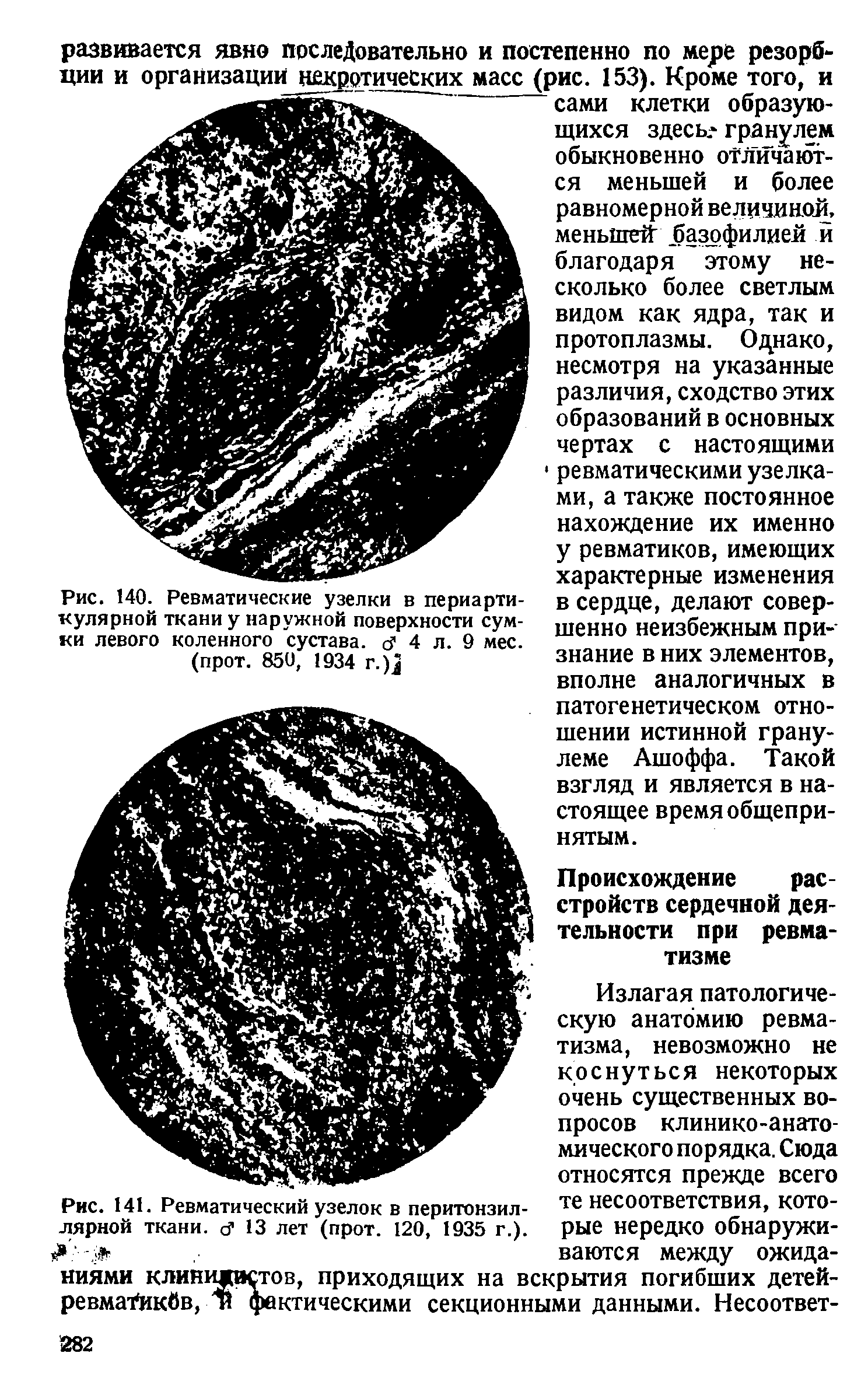 Рис. 141. Ревматический узелок в перитонзил-лярной ткани, 1 13 лет (прот. 120, 1935 г.).