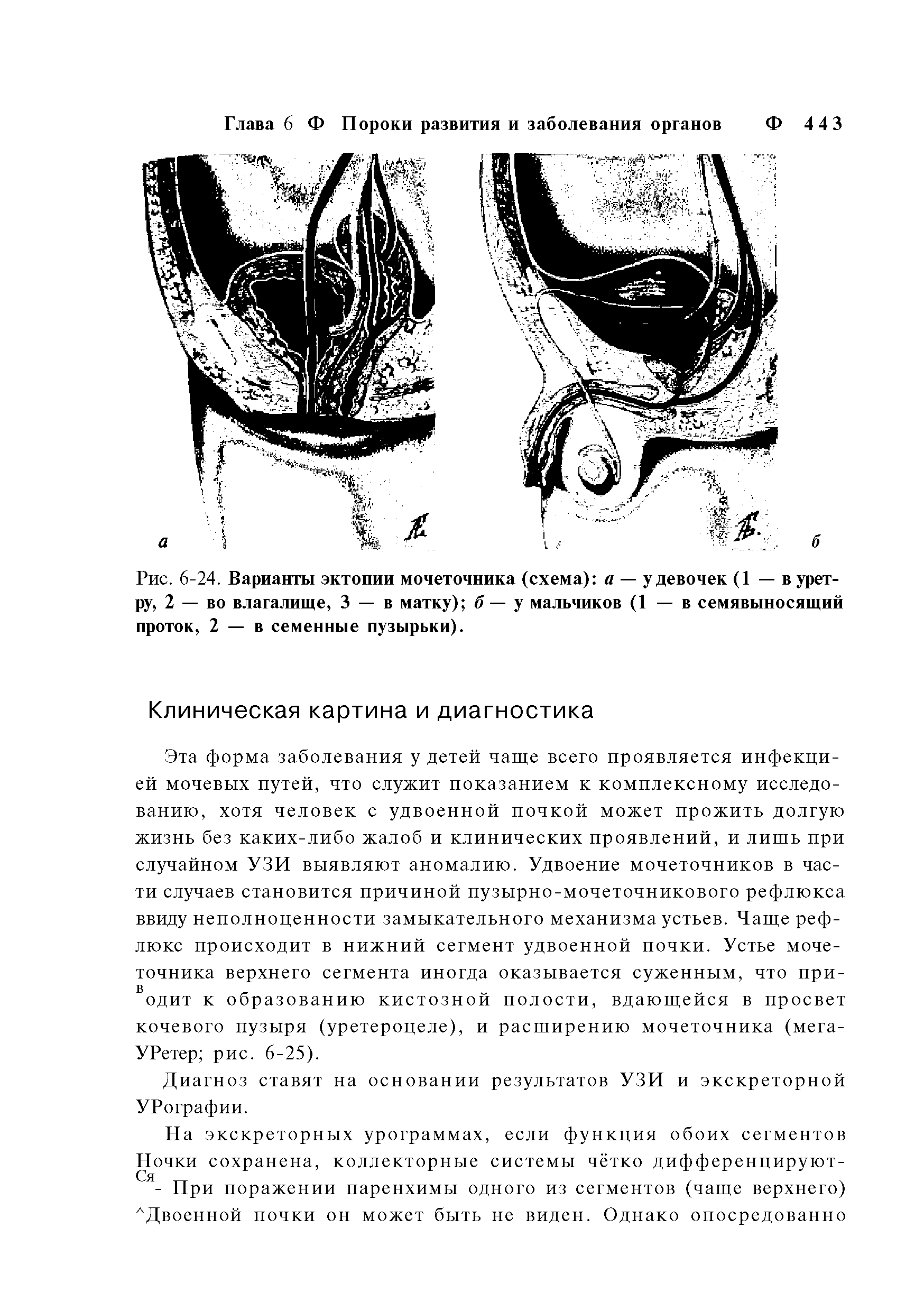 Рис. 6-24. Варианты эктопии мочеточника (схема) а — у девочек (1 — в уретру, 2 — во влагалище, 3 — в матку) б — у мальчиков (1 — в семявыносящий проток, 2 — в семенные пузырьки).