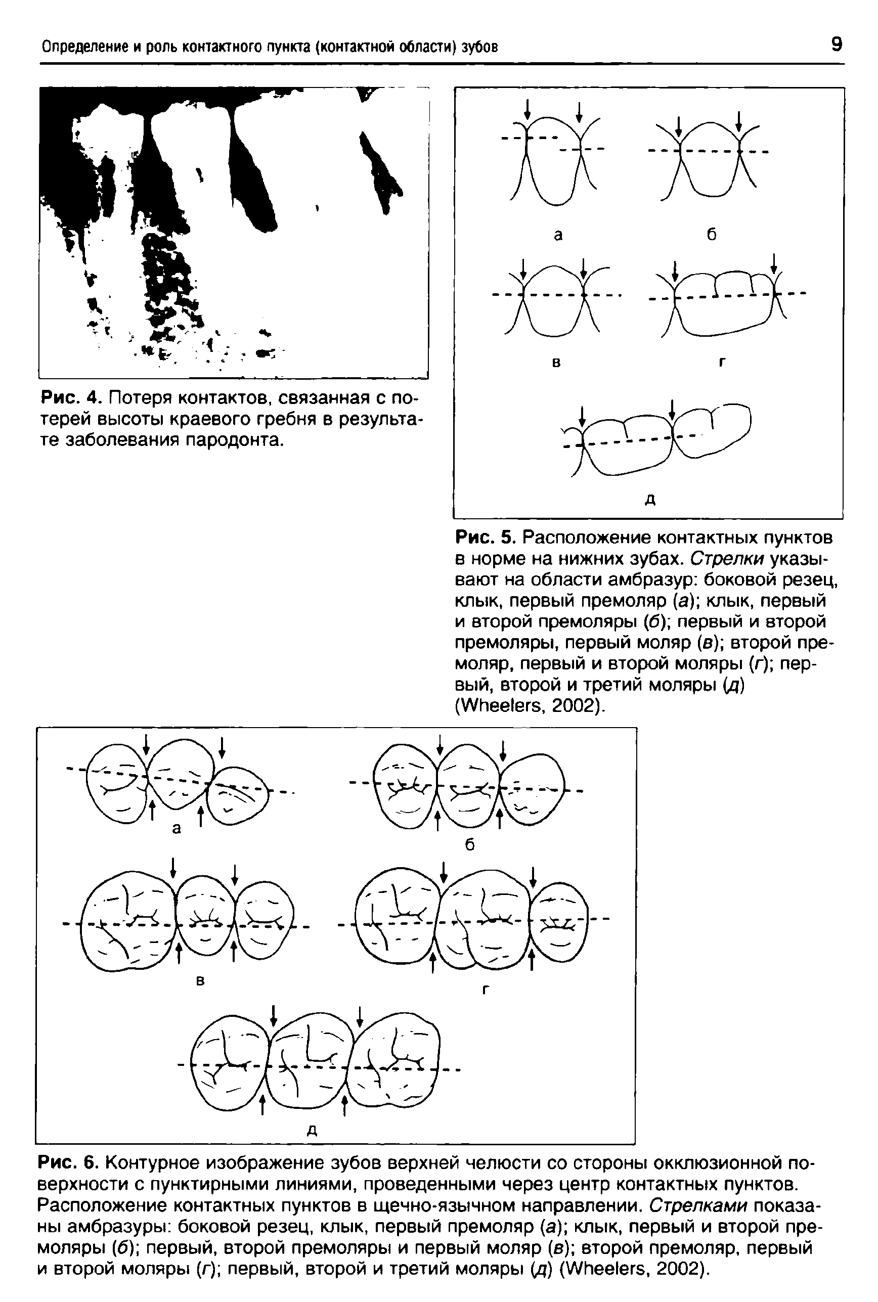 Рис. 5. Расположение контактных пунктов в норме на нижних зубах. Стрелки указывают на области амбразур боковой резец, клык, первый премоляр (а) клык, первый и второй премоляры (б) первый и второй премоляры, первый моляр (в) второй премоляр, первый и второй моляры (г) первый, второй и третий моляры (д) (W , 2002).