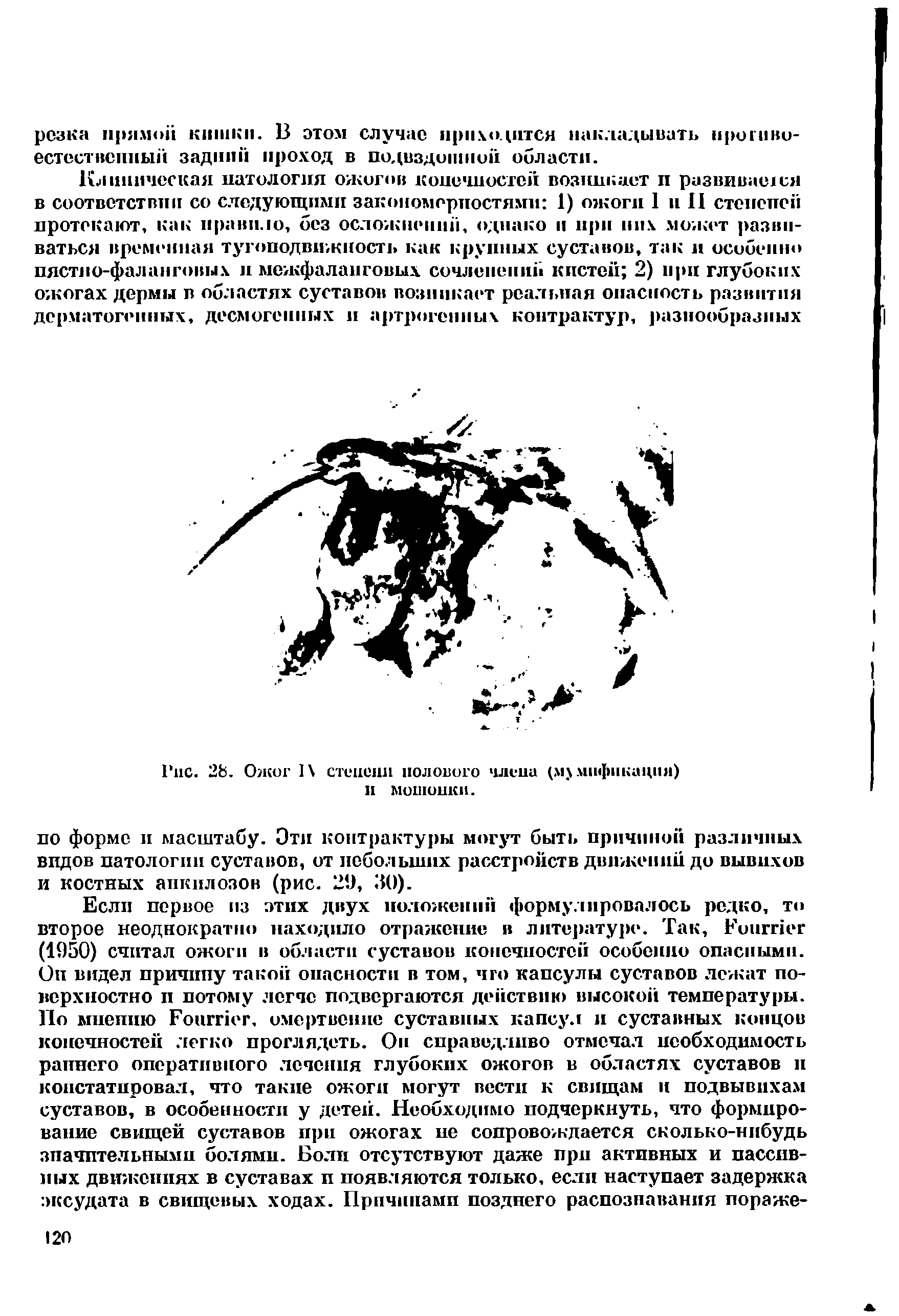 Рис. 28. Ожог 1 степени полового члена (мхиифпкация) и мошонки.