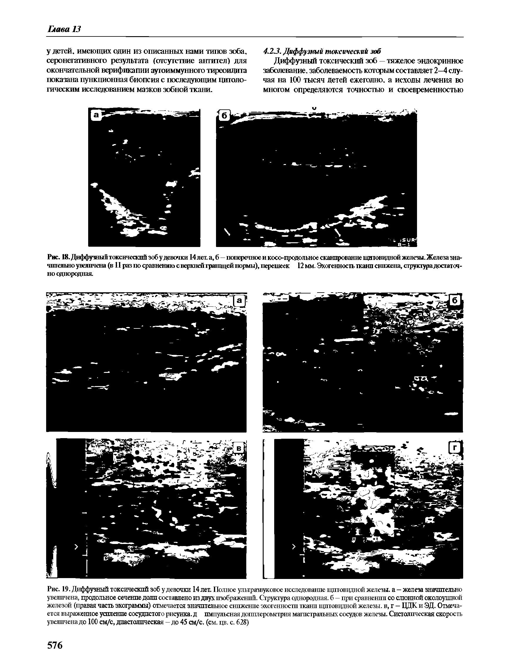 Рис. 18. Диффузный токсичеоспй зоб у девочки 14 лет. а, б—поперечное и косо-продольное сканирование щитовидной железы.Железа значительно увеличена (в 11 раз по сравнению с верхней границей нормы), перешеек 12 мм. Эхогенность ткани снижена, структура достаточно однородная.