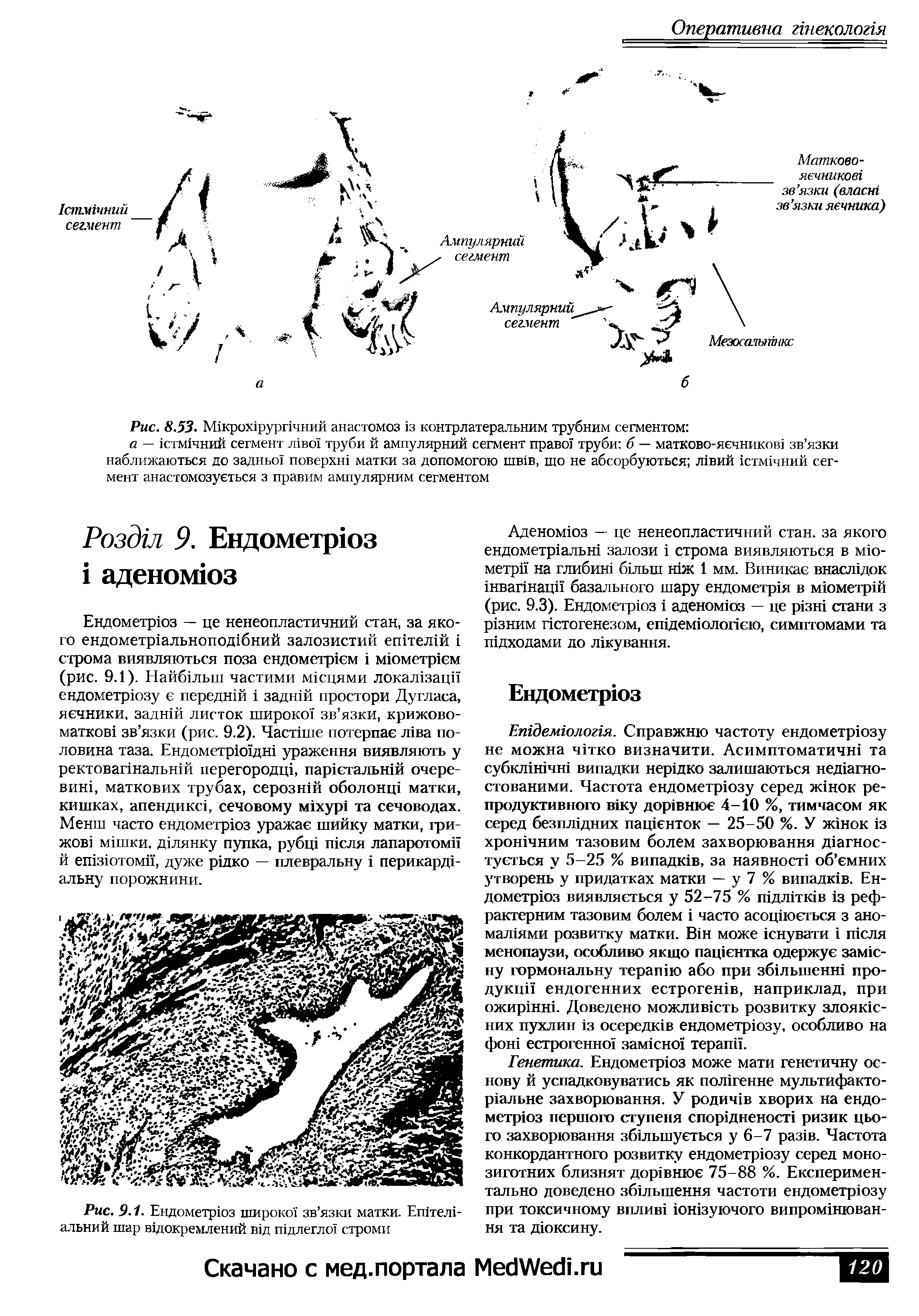 Рис. 9.1. Ендометрюз широко зв язки матки. Егатель альний шар в1докремлений вщ шдлегло строми...