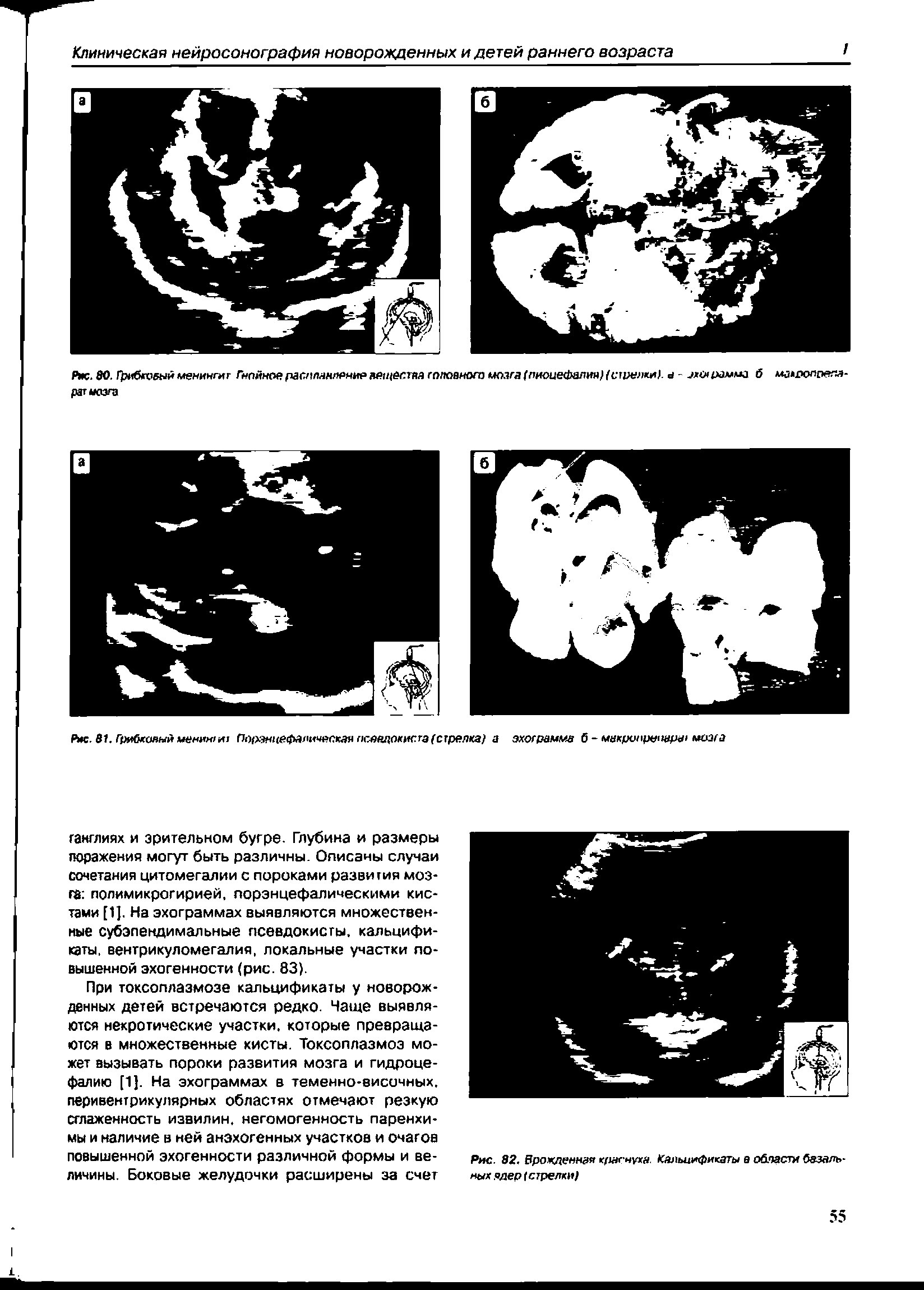 Рис. 80.Грибкоеыи менингит Гнойное раснммленне м/цеспа головного мозга (пиоиефалин) (стрелки/. а - зх рамма б мавоолоелл-рат мозга...