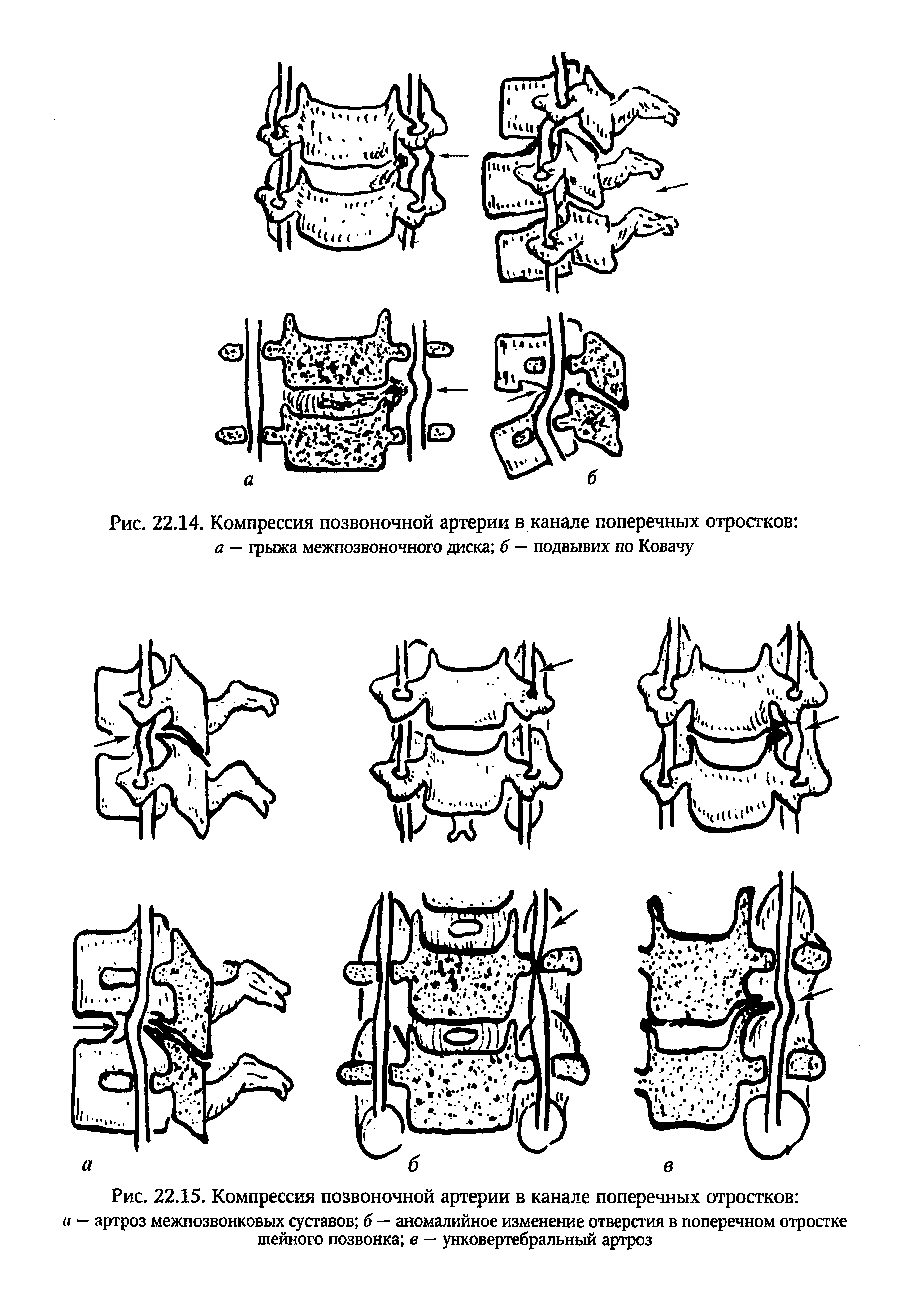 Рис. 22.15. Компрессия позвоночной артерии в канале поперечных отростков и — артроз межпозвонковых суставов б — аномалийное изменение отверстия в поперечном отростке шейного позвонка в — унковертебральный артроз...