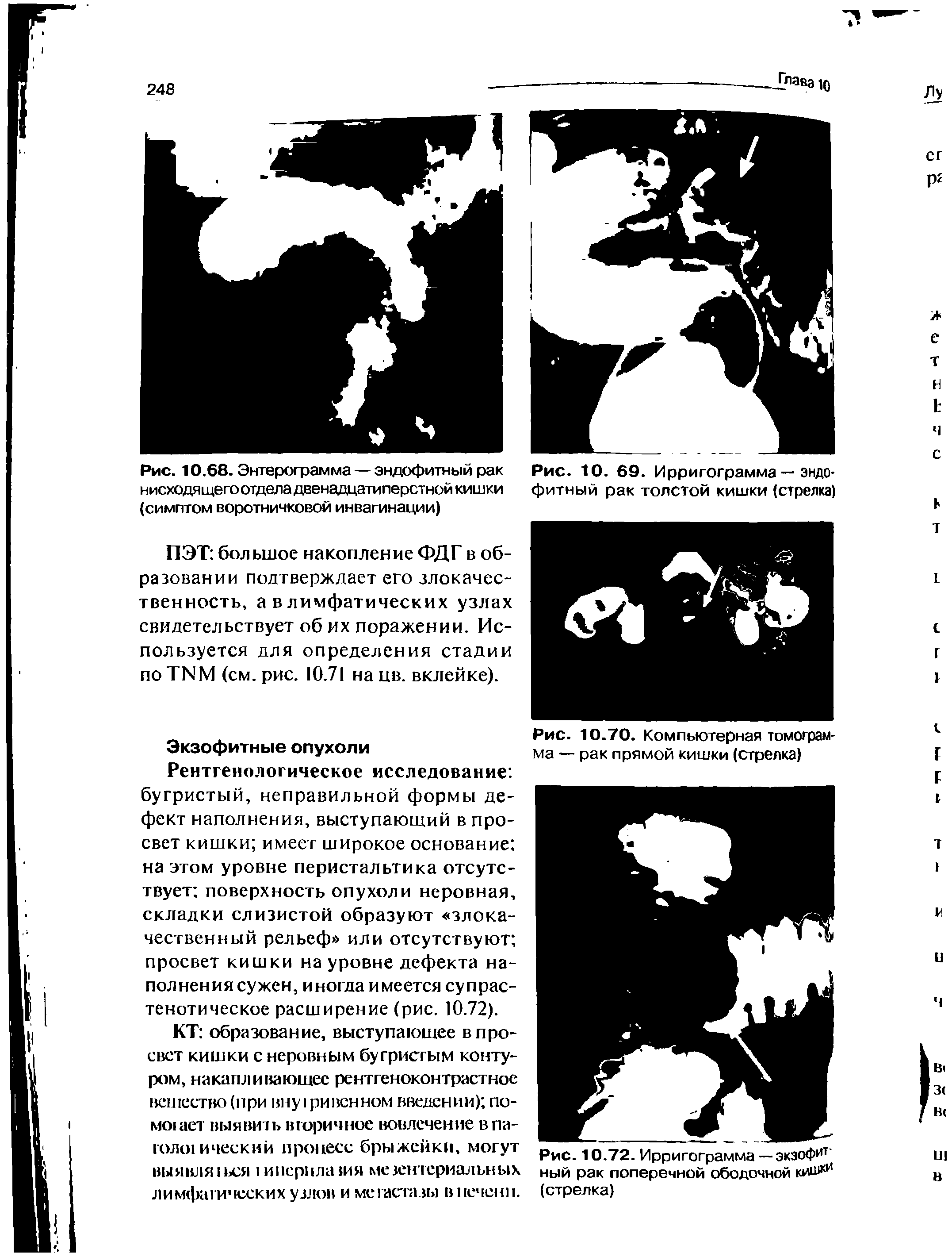 Рис. 10.68. Энтерограмма — эндофитный рак нисходящего отдела двенадцатиперстной кишки (симптом воротничковой инвагинации)...