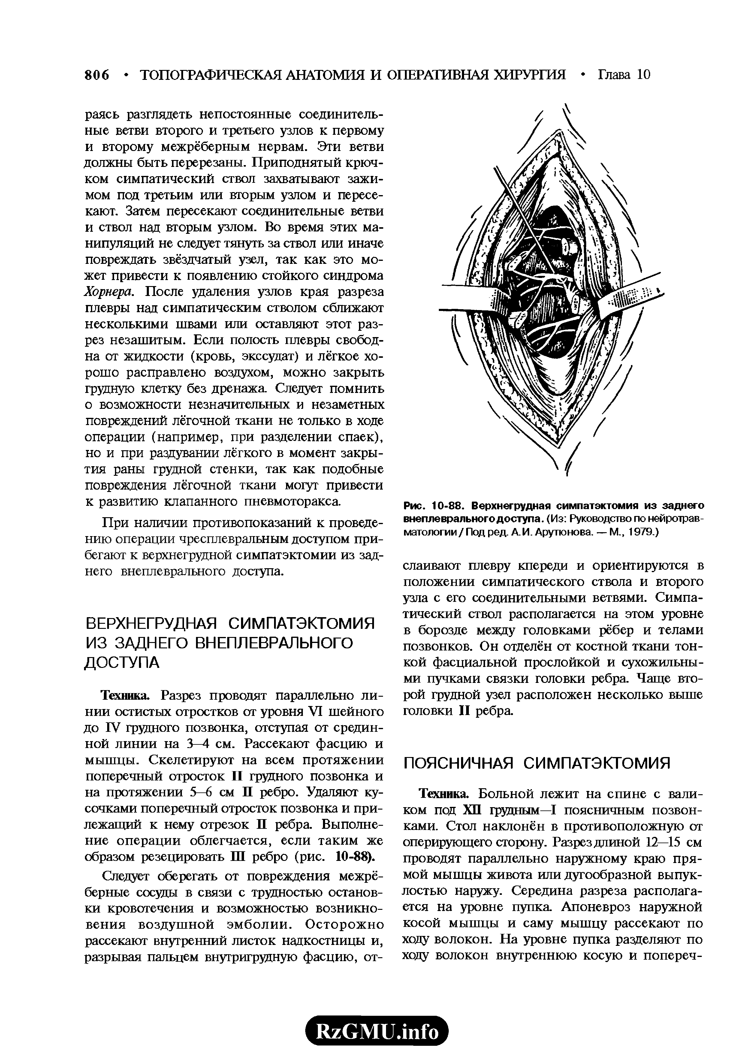 Рис. 10-88. Верхнегрудная симпатэктомия из заднего внеплеврального доступа. (Из Руководство по нейротравматологии / Под ред. А. И. Арутюнова. — М., 1979.)...
