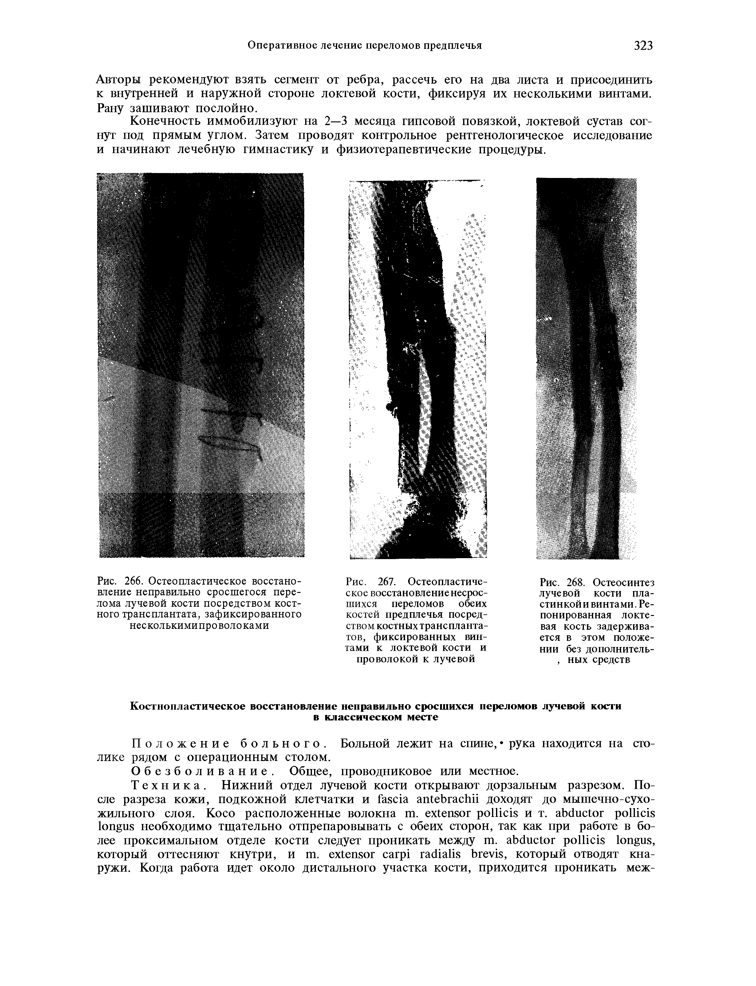 Рис. 267. Остеопластическое восстановление несрос-шихся переломов обеих костей предплечья посредством костных трансплантатов, фиксированных винтами к локтевой кости и проволокой к лучевой...