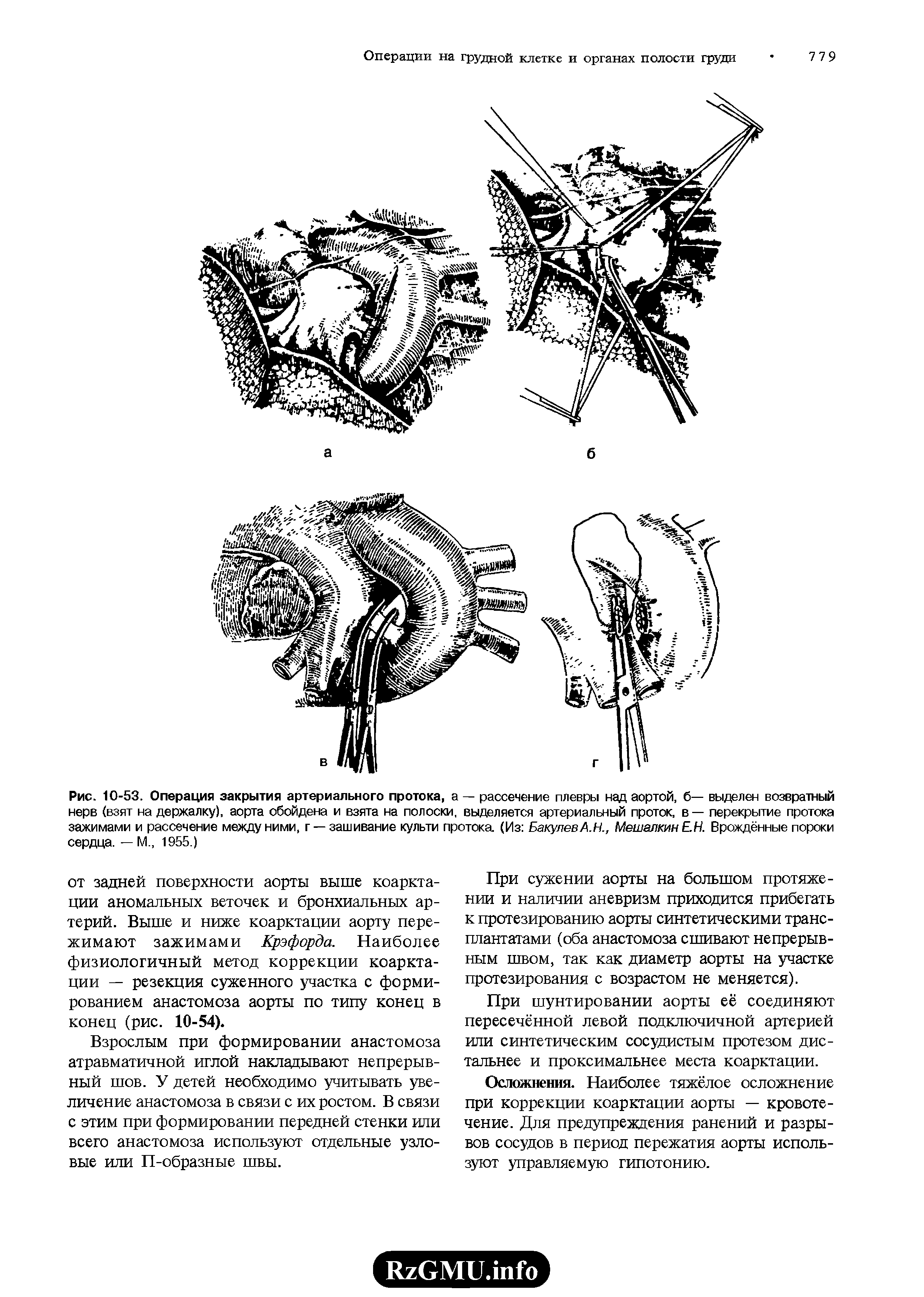 Рис. 10-53. Операция закрытия артериального протока, а — рассечение плевры над аортой, б— выделен возвратный нерв (взят на держалку), аорта обойдена и взята на полоски, выделяется артериальный проток, в — перекрытие протока зажимами и рассечение между ними, г —зашивание культи протока. (Из БакулевА.Н., Мешалкин ЕН. Врождённые пороки сердца. — М., 1955.)...