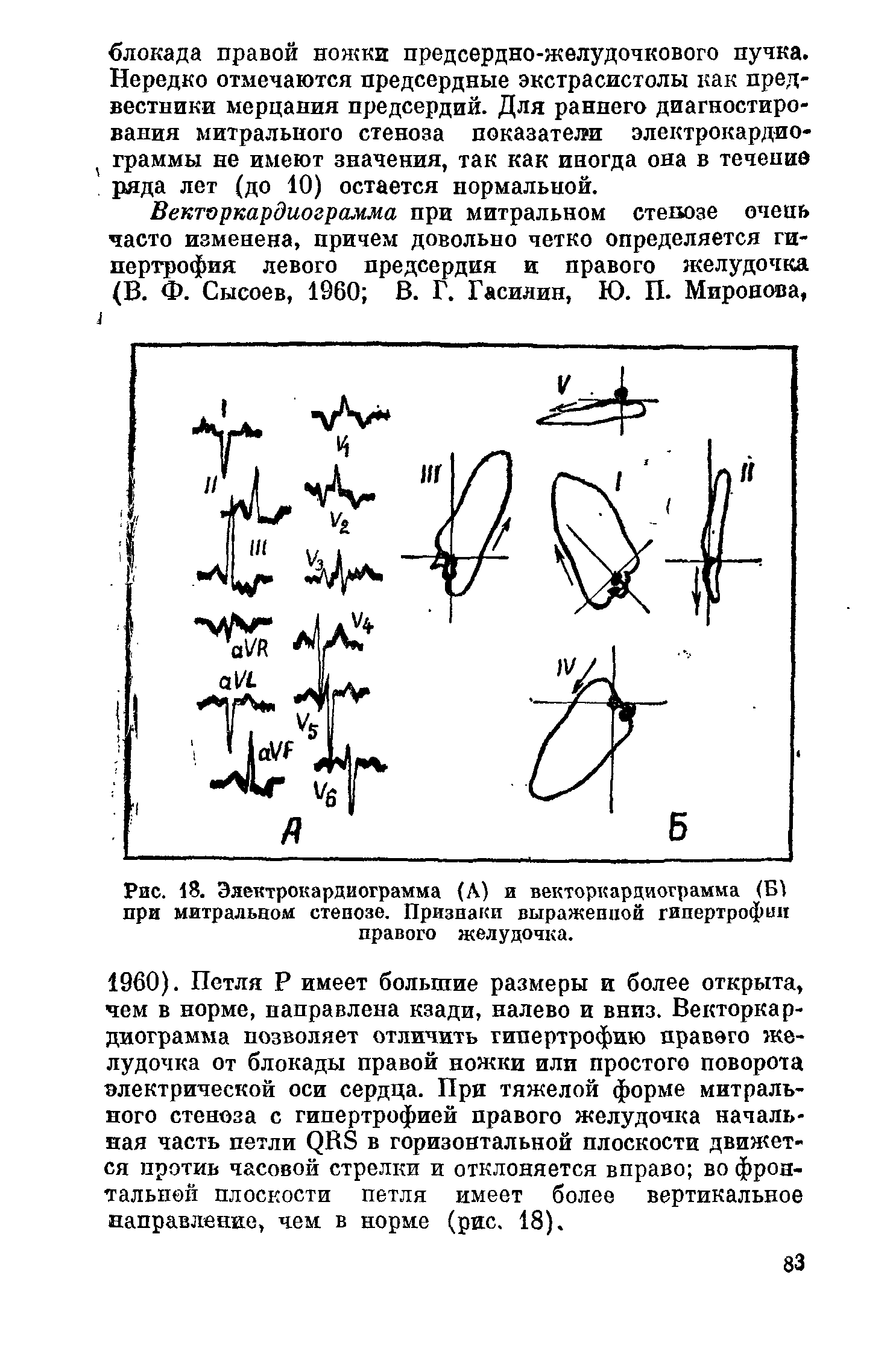 Рис. 18. Электрокардиограмма (Л) и векторкардиограмма (Б1 при митральном стенозе. Признаки выраженной гипертрофии правого желудочка.